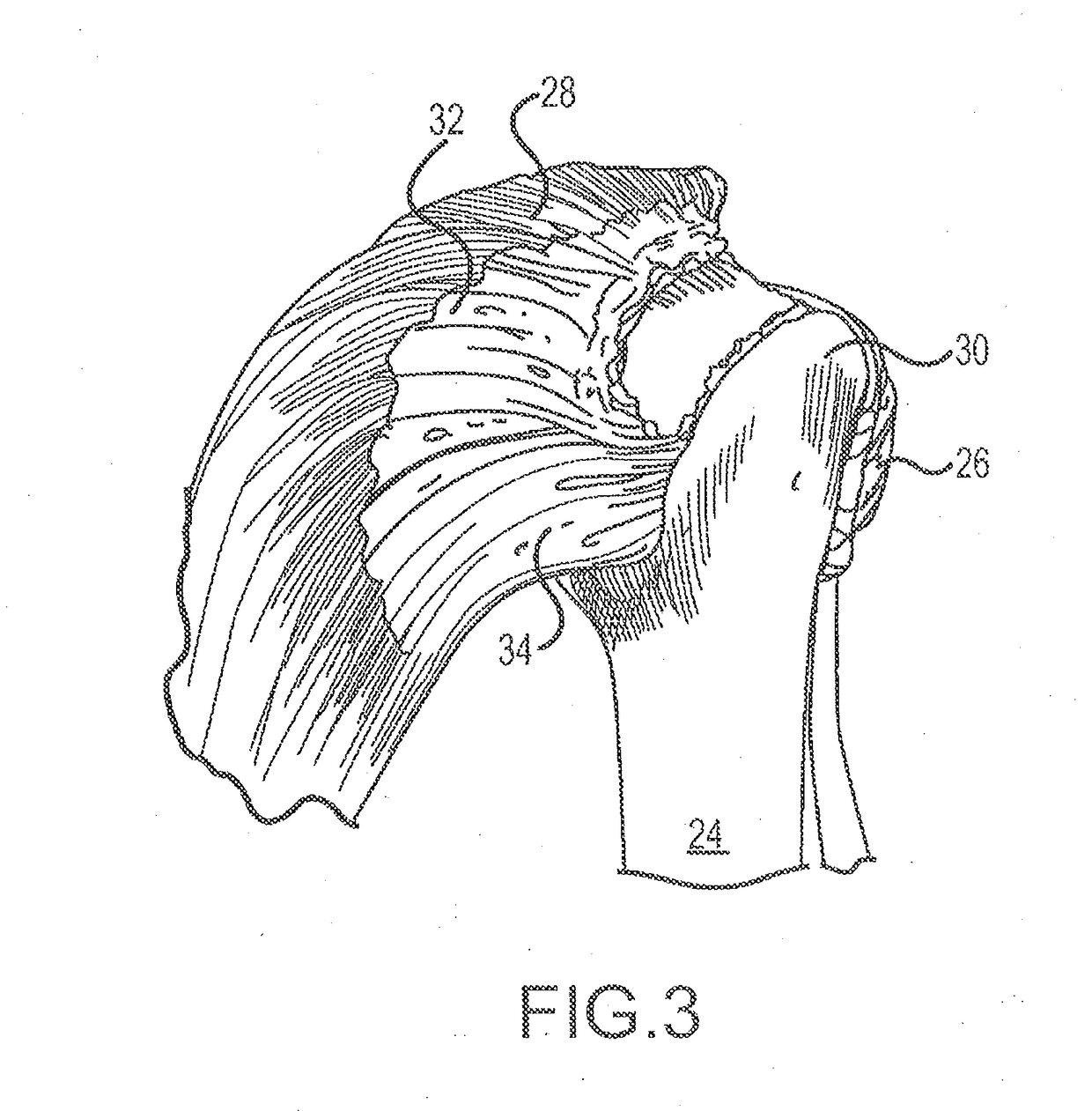 Suture sleeve patch and methods of delivery within an existing arthroscopic workflow