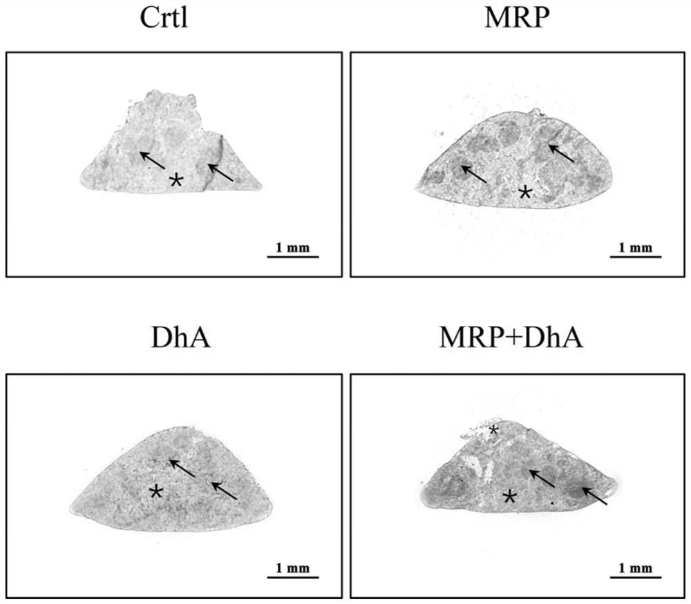 Application of dihydroartemisinin in preparation of medicine for treating inflammation caused by virulence protein of streptococcus suis