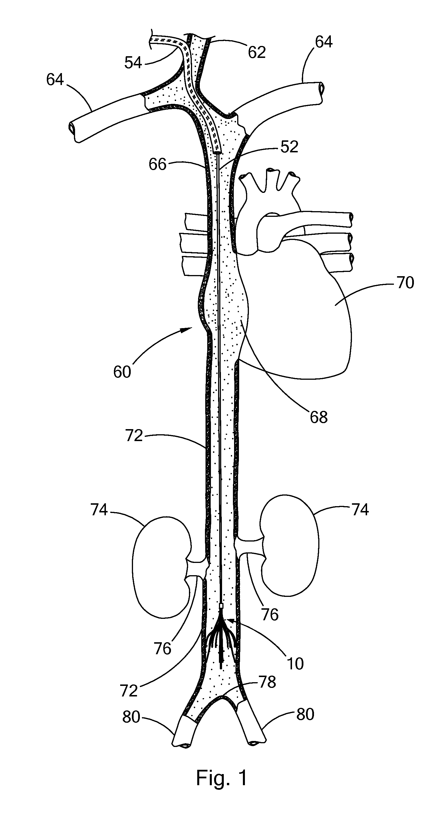 Temporary venous filter with Anti-coagulant delivery method