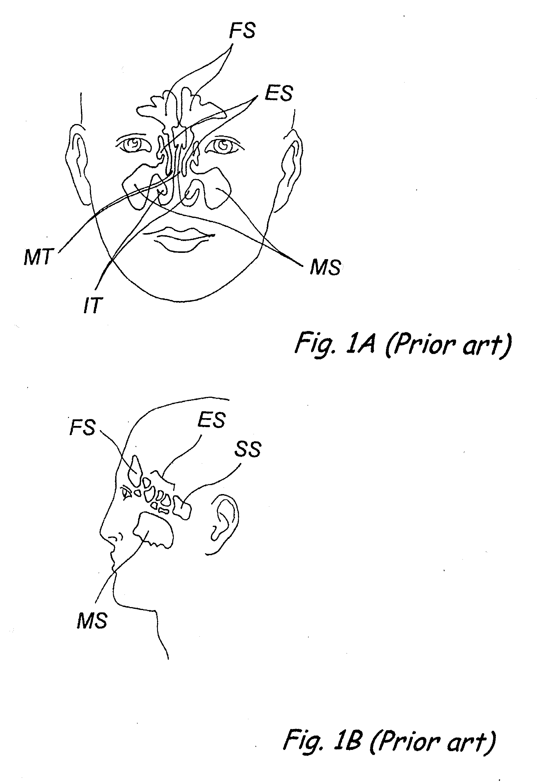 Devices, Systems and Methods For Diagnosing and Treating Sinusitis and Other Disorders of the Ears, Nose and/or Throat