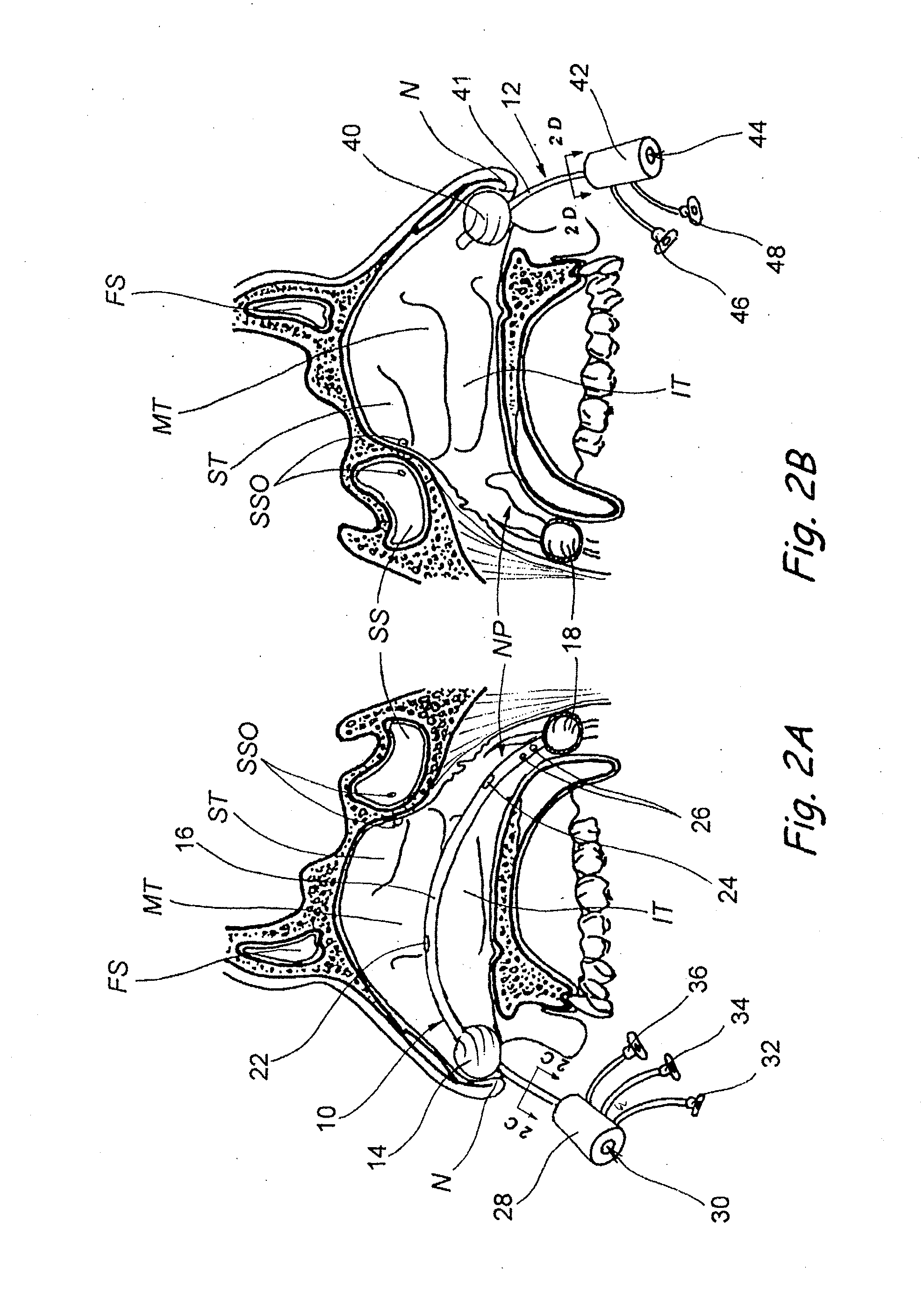Devices, Systems and Methods For Diagnosing and Treating Sinusitis and Other Disorders of the Ears, Nose and/or Throat