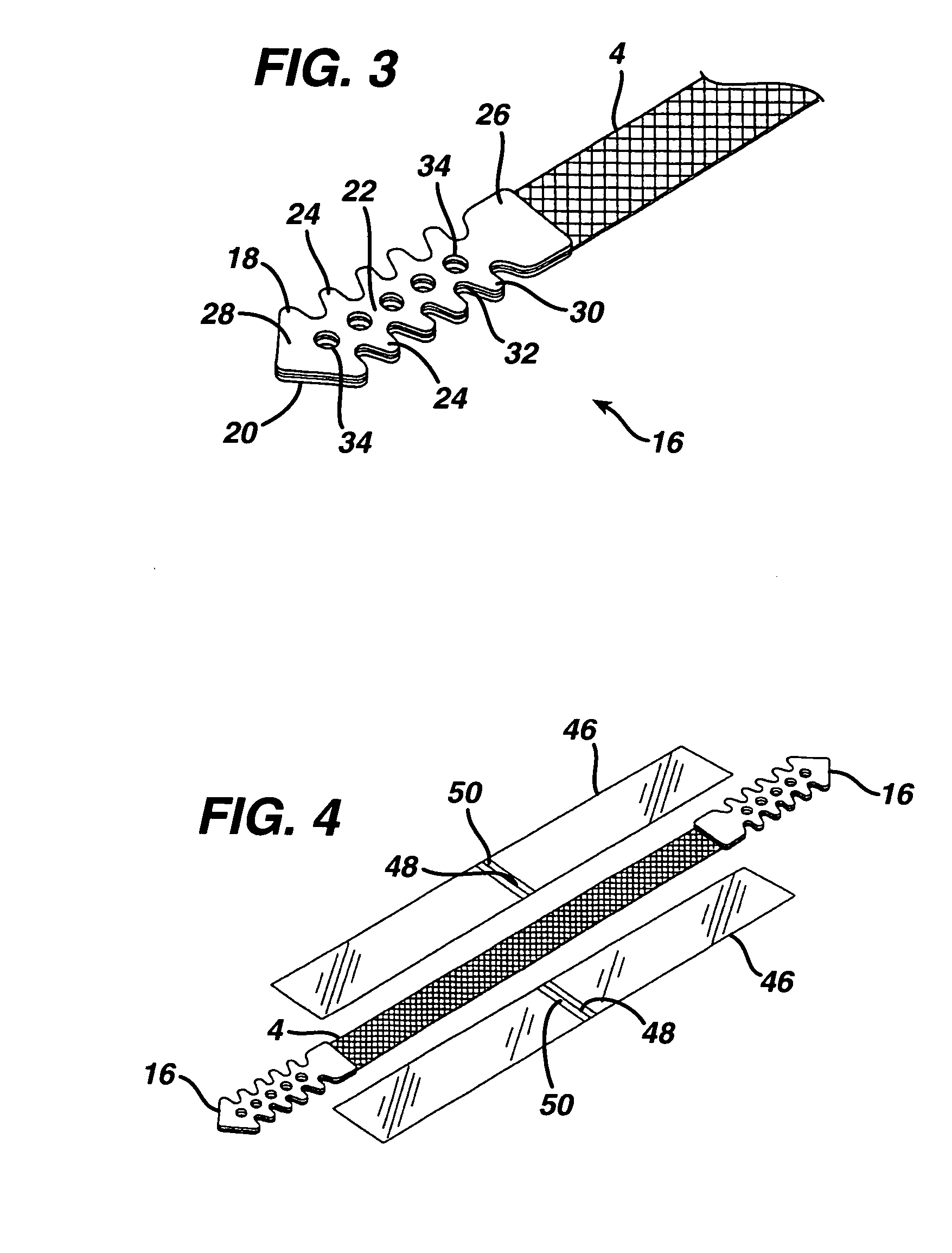Minimally invasive medical implant and insertion device and method for using the same