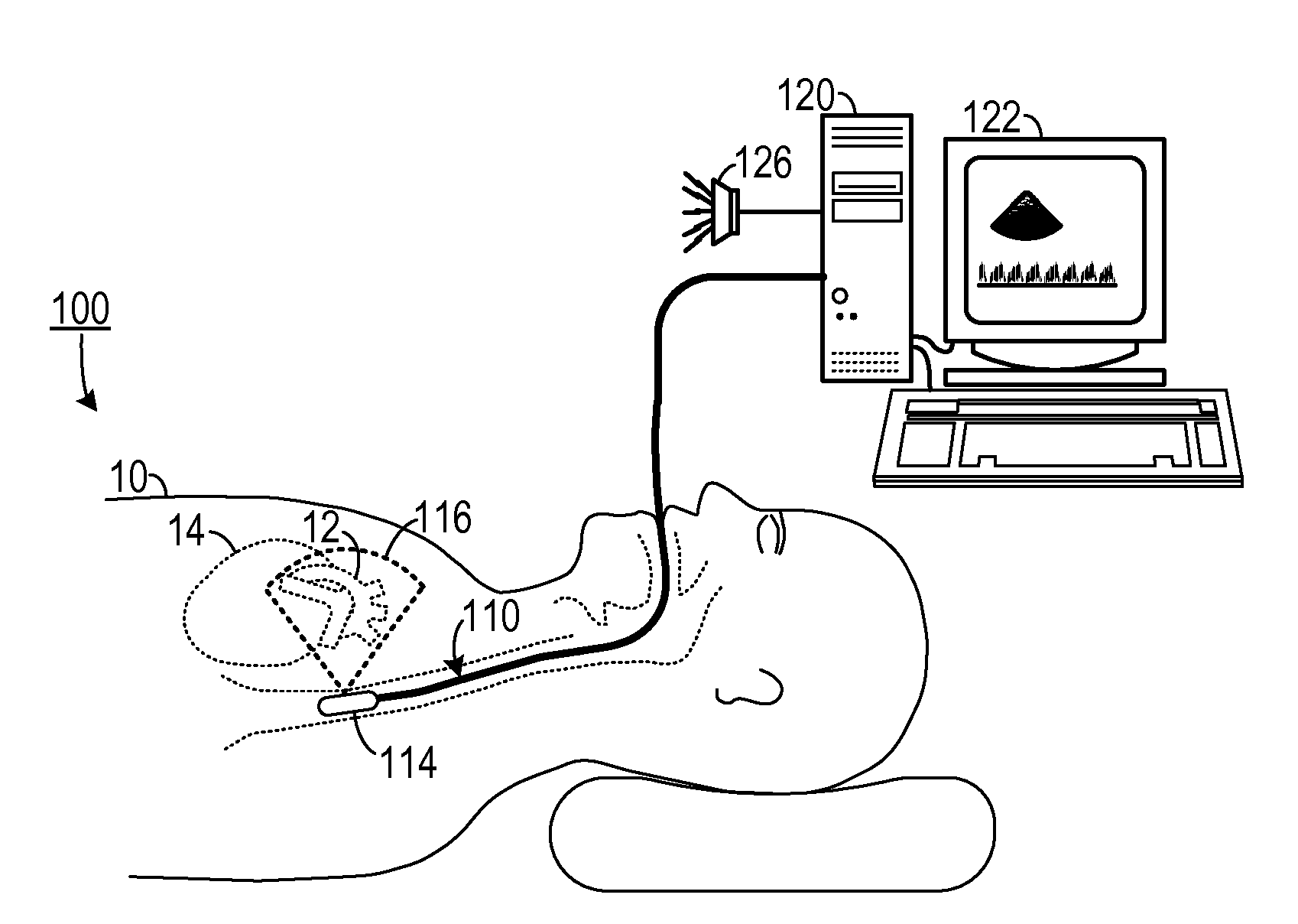 Microembolic signals detection during cordiopulmonary bypass