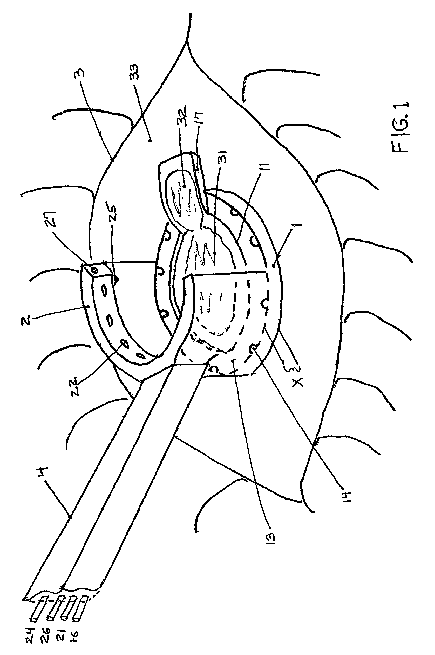 Multi-function surgical instrument for facilitating ophthalmic laser surgery