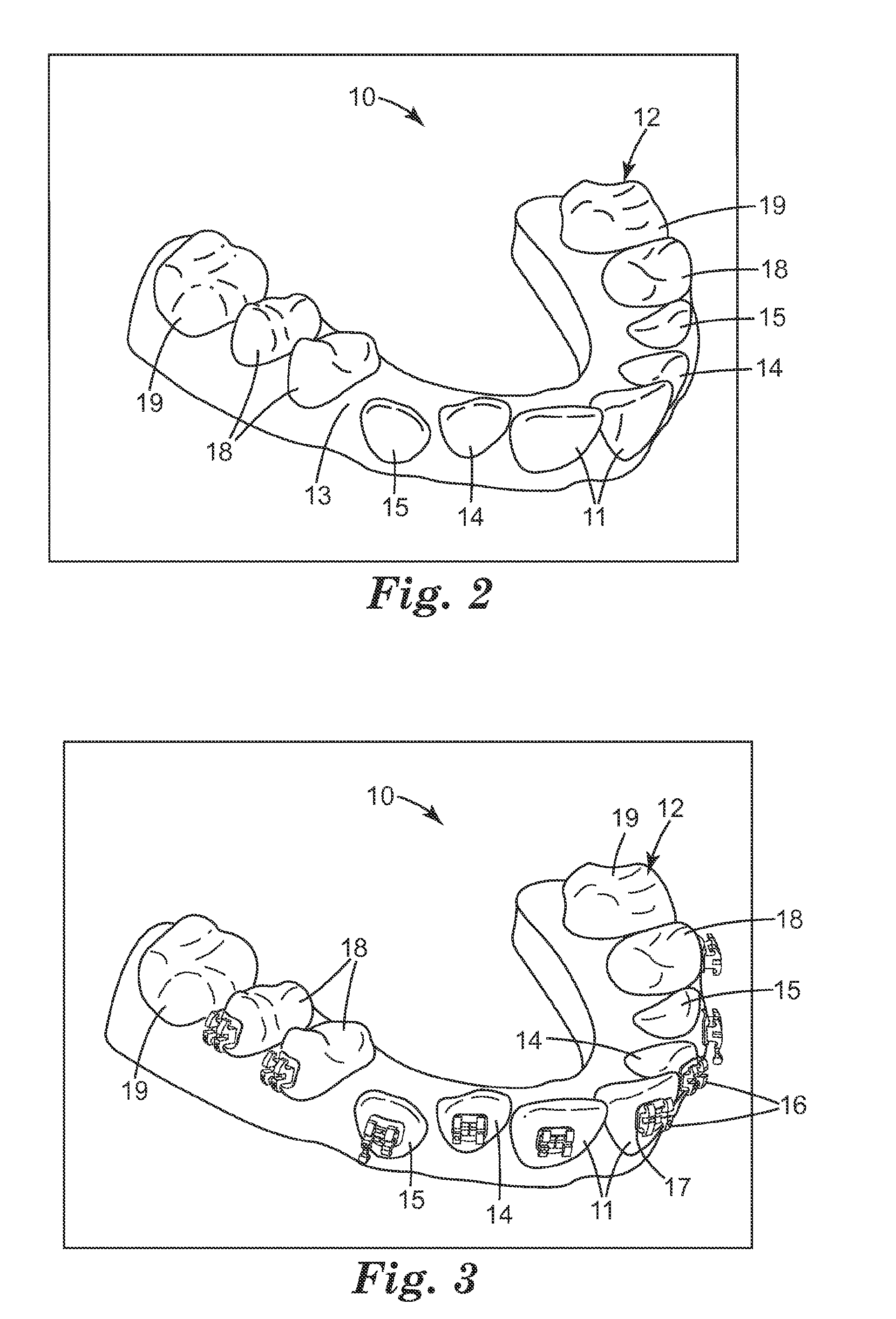 Rapid prototyped transfer tray for orthodontic appliances