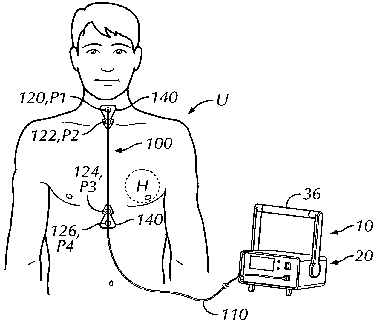 Thoracic impedance monitor and electrode array and method of use