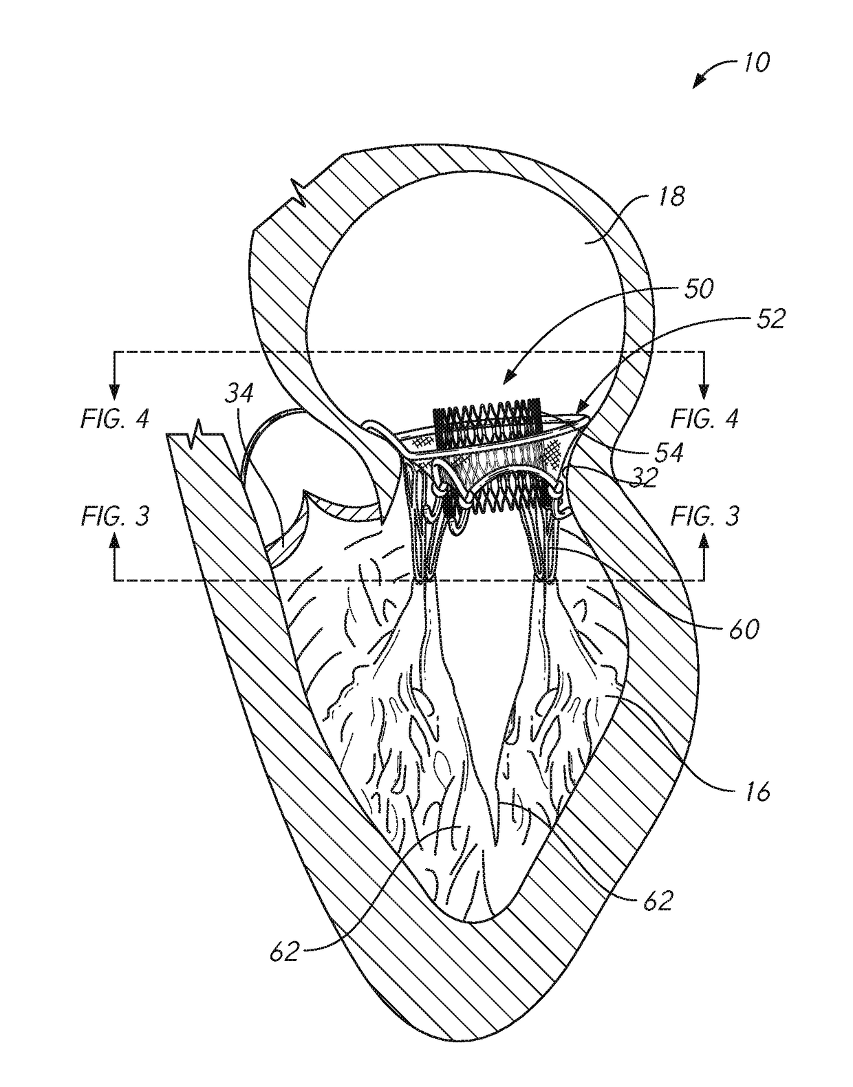 Mitral valve prosthesis