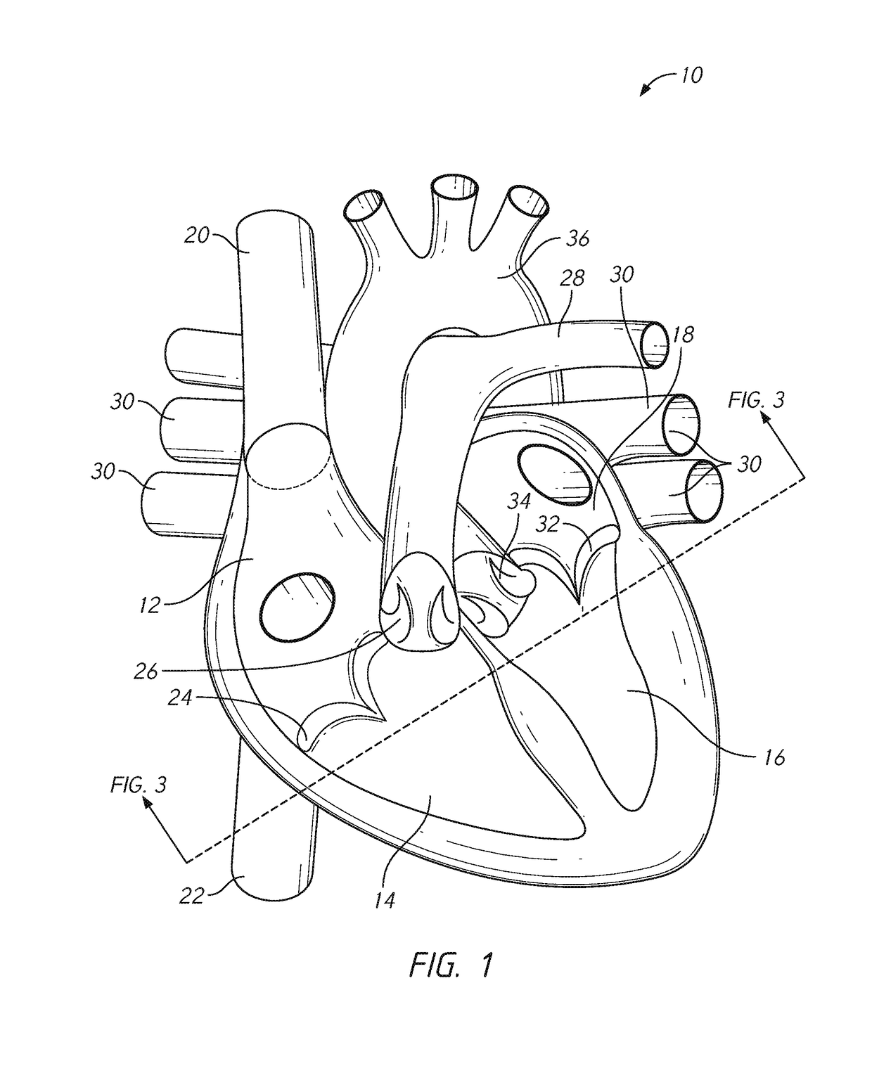 Mitral valve prosthesis