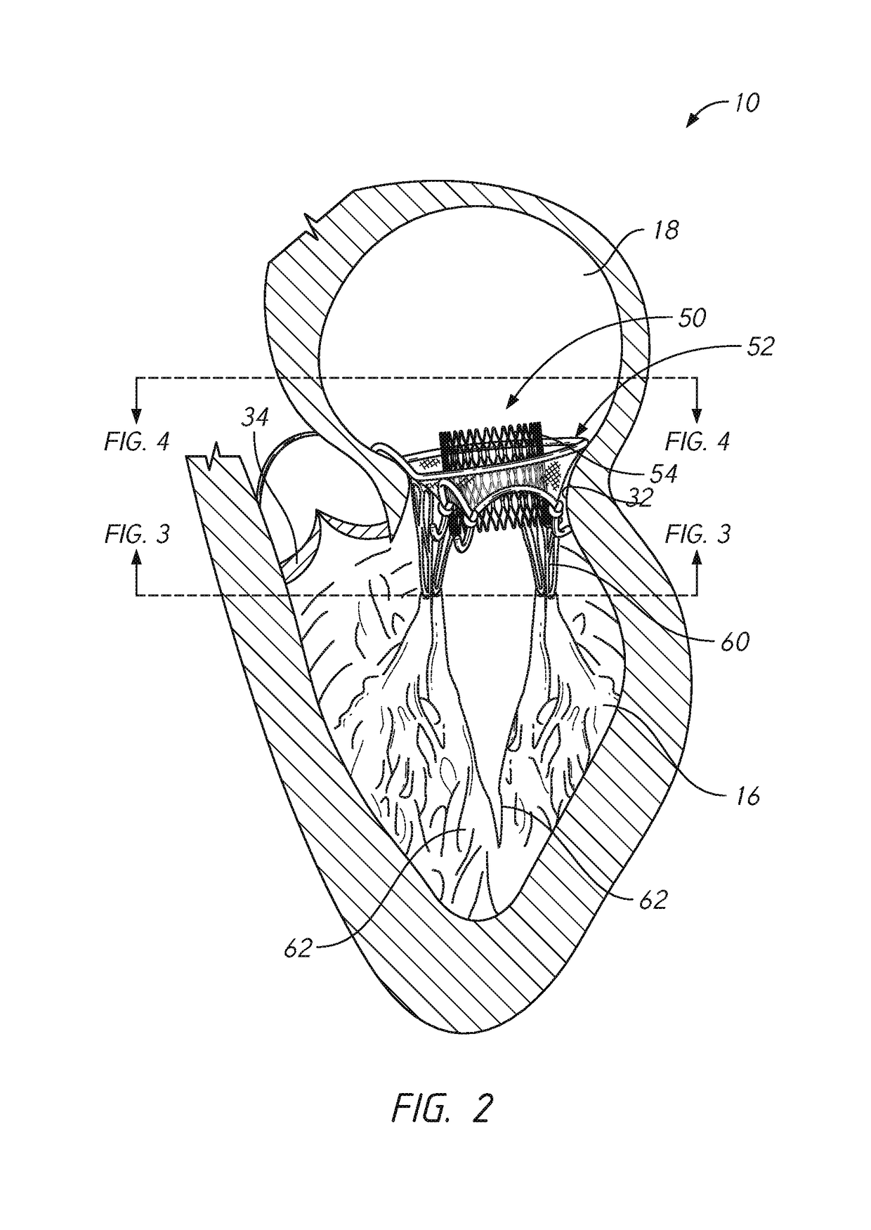 Mitral valve prosthesis