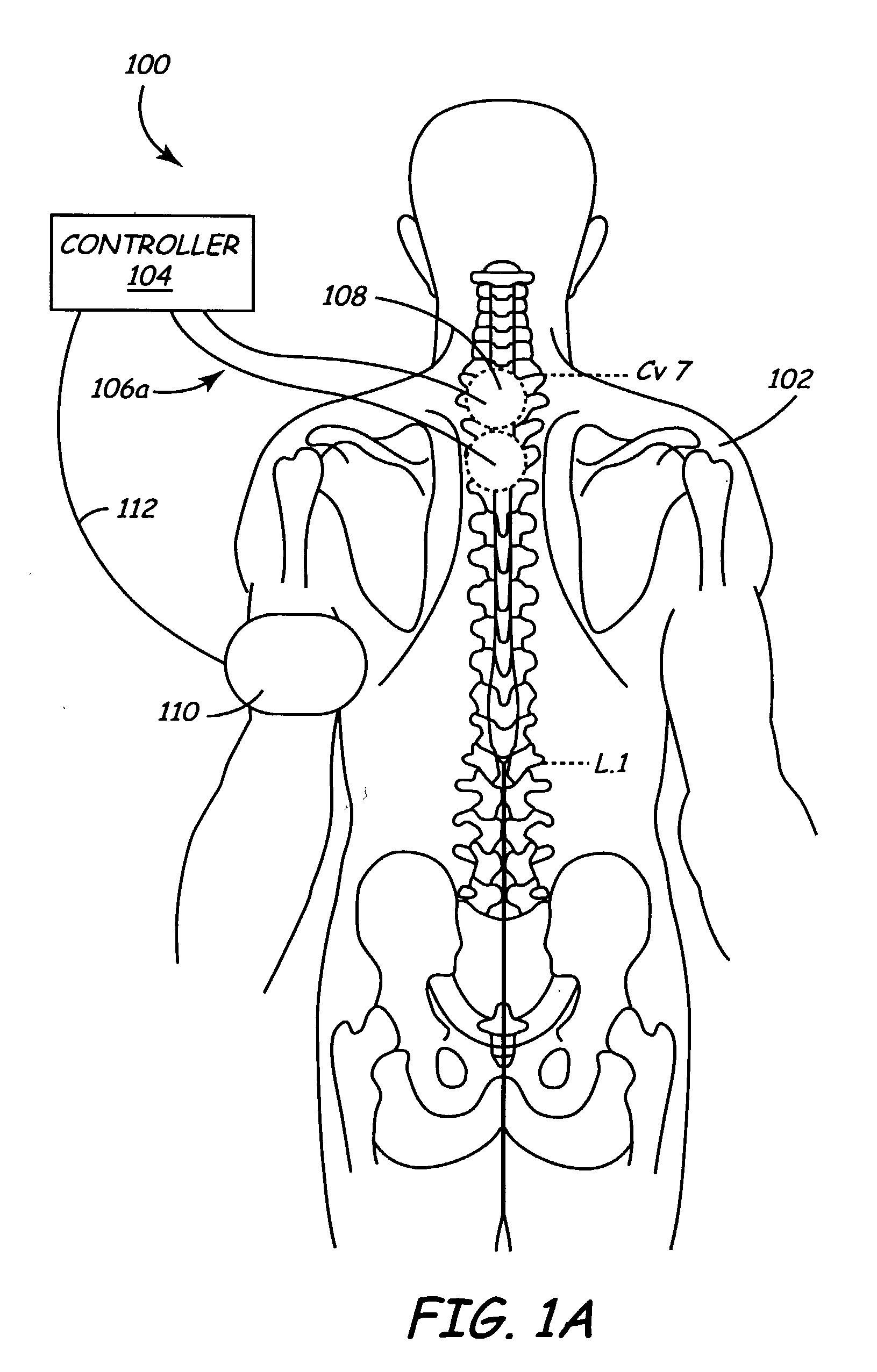 Method and apparatus for electrically stimulating the nervous system to improve ventricular dysfunction, heart failure, and other cardiac conditions