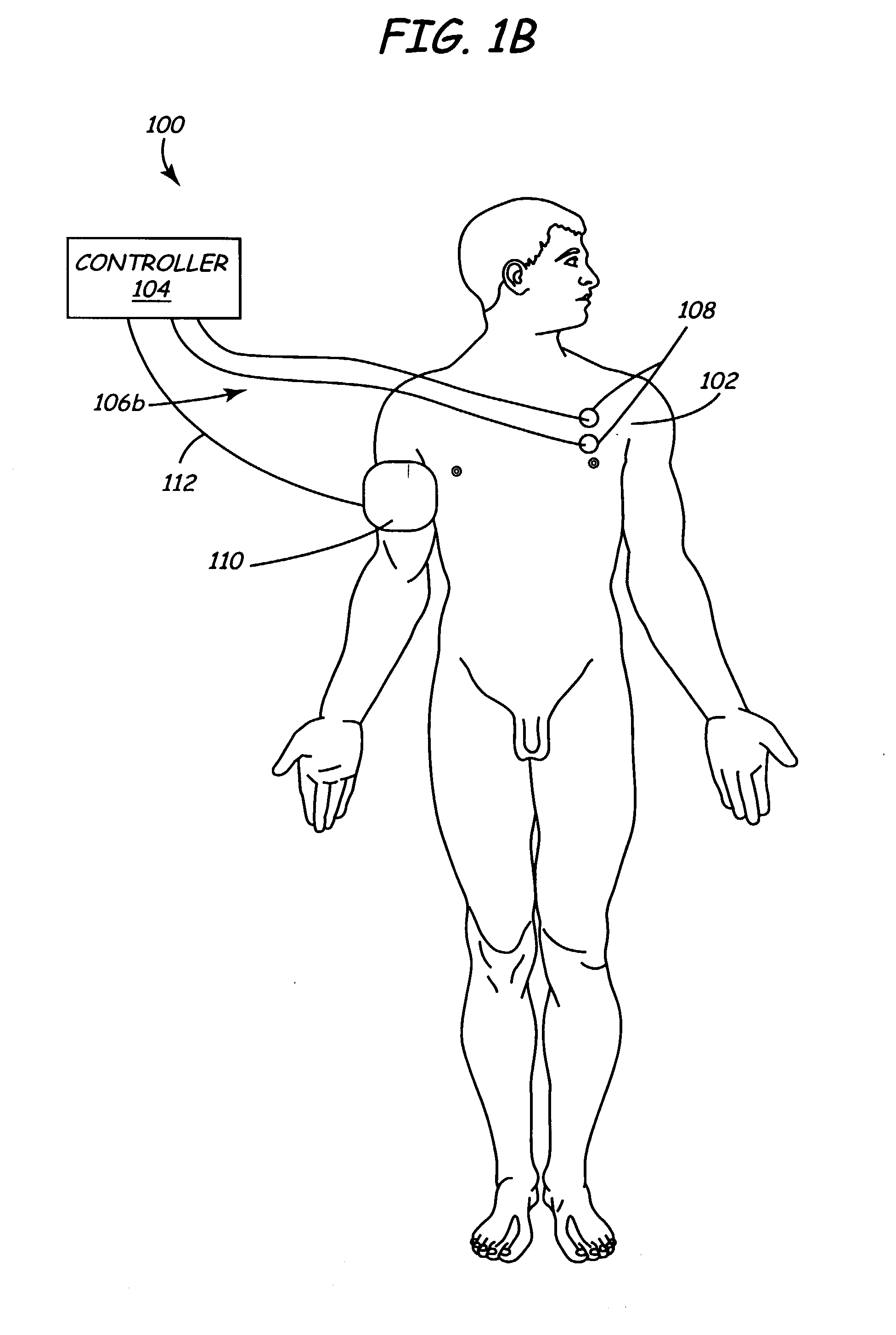 Method and apparatus for electrically stimulating the nervous system to improve ventricular dysfunction, heart failure, and other cardiac conditions