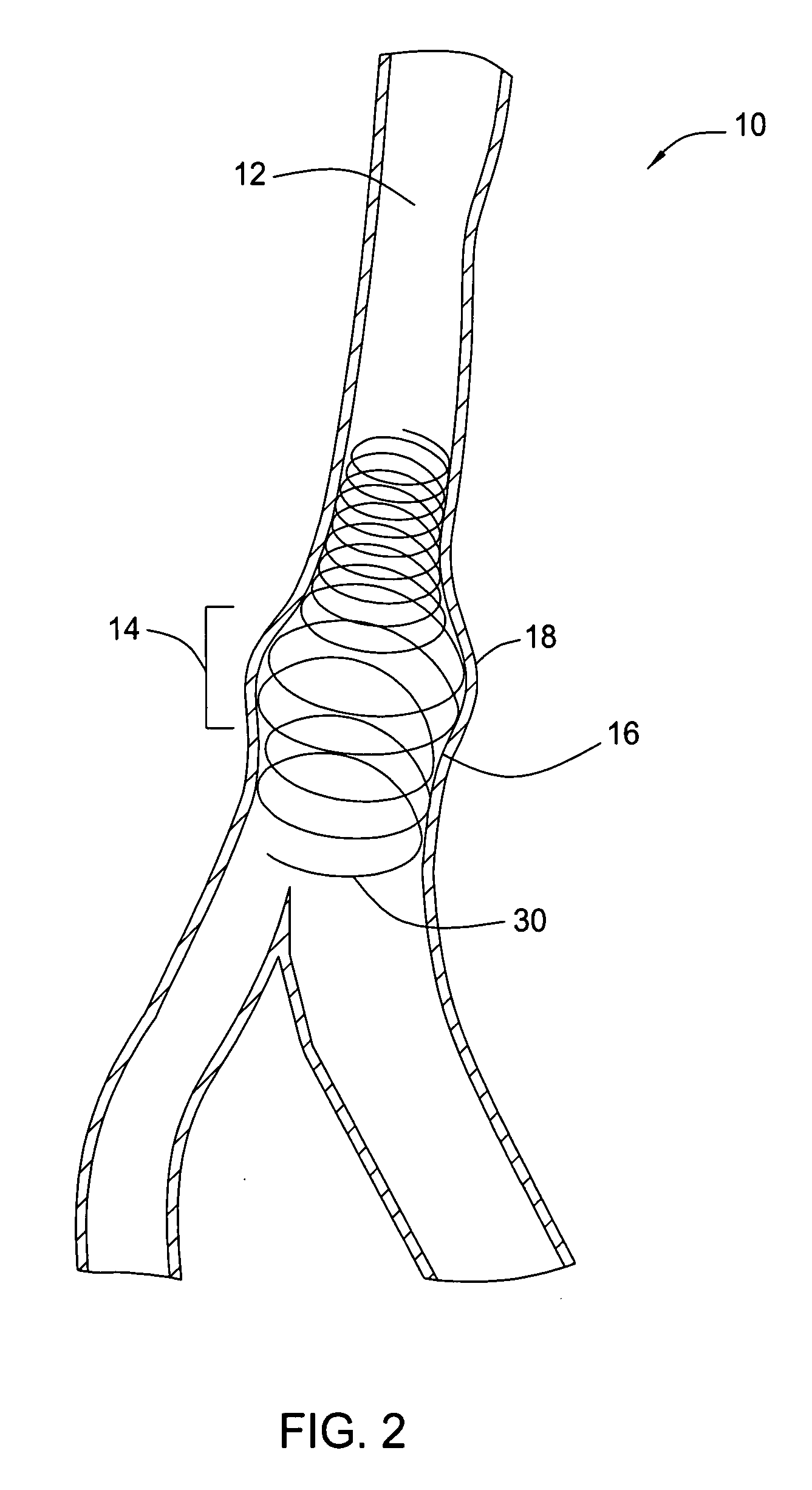 Methods and apparatus for treatment of aneurysmal tissue