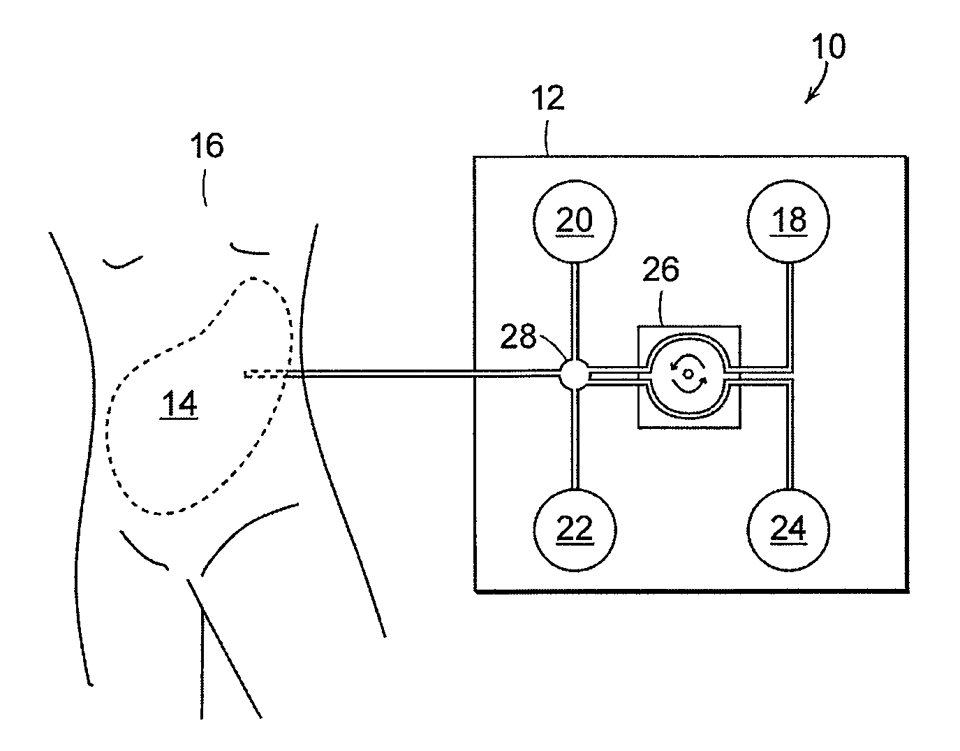 Early stage peritonitis detection apparatus and methods