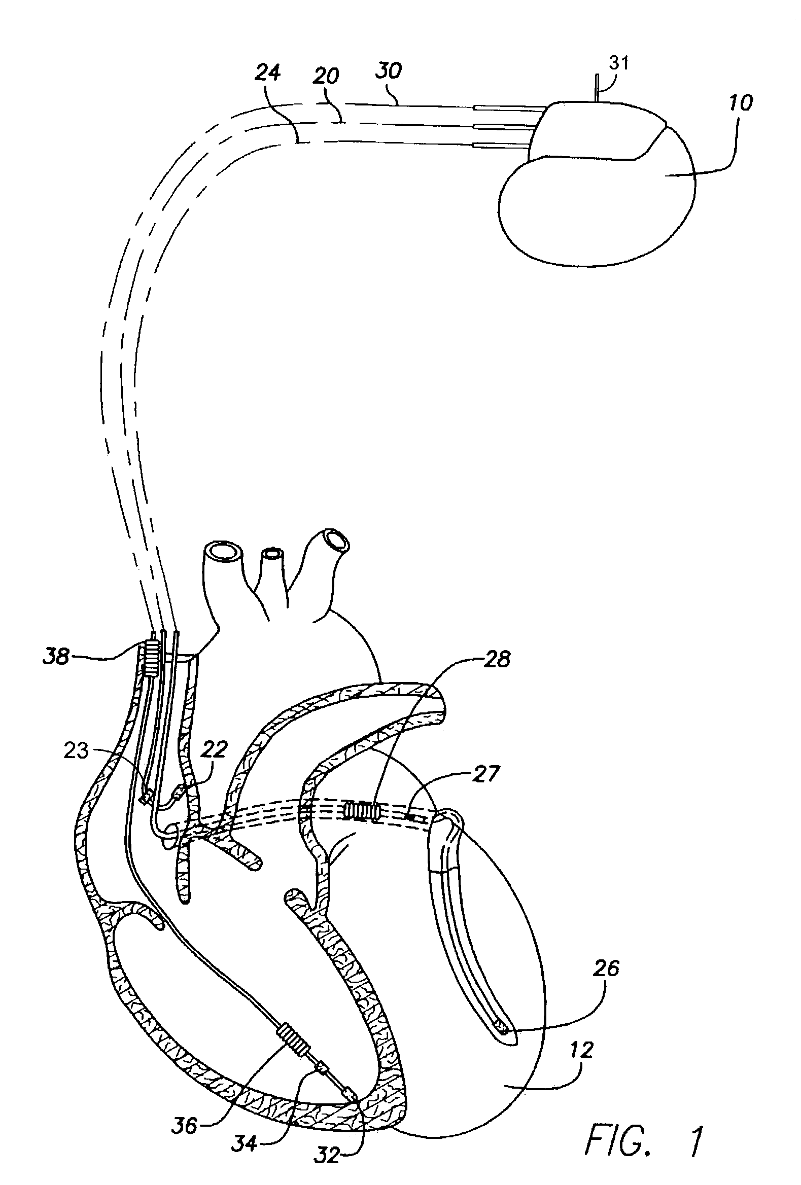 System and method for detecting cardiac ischemia based on T-waves using an implantable medical device