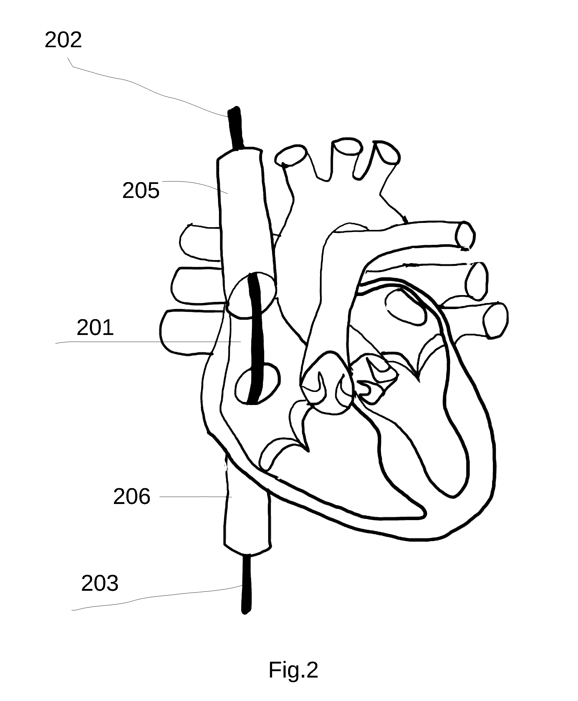 System and method for treating hepatic area vein occlusion