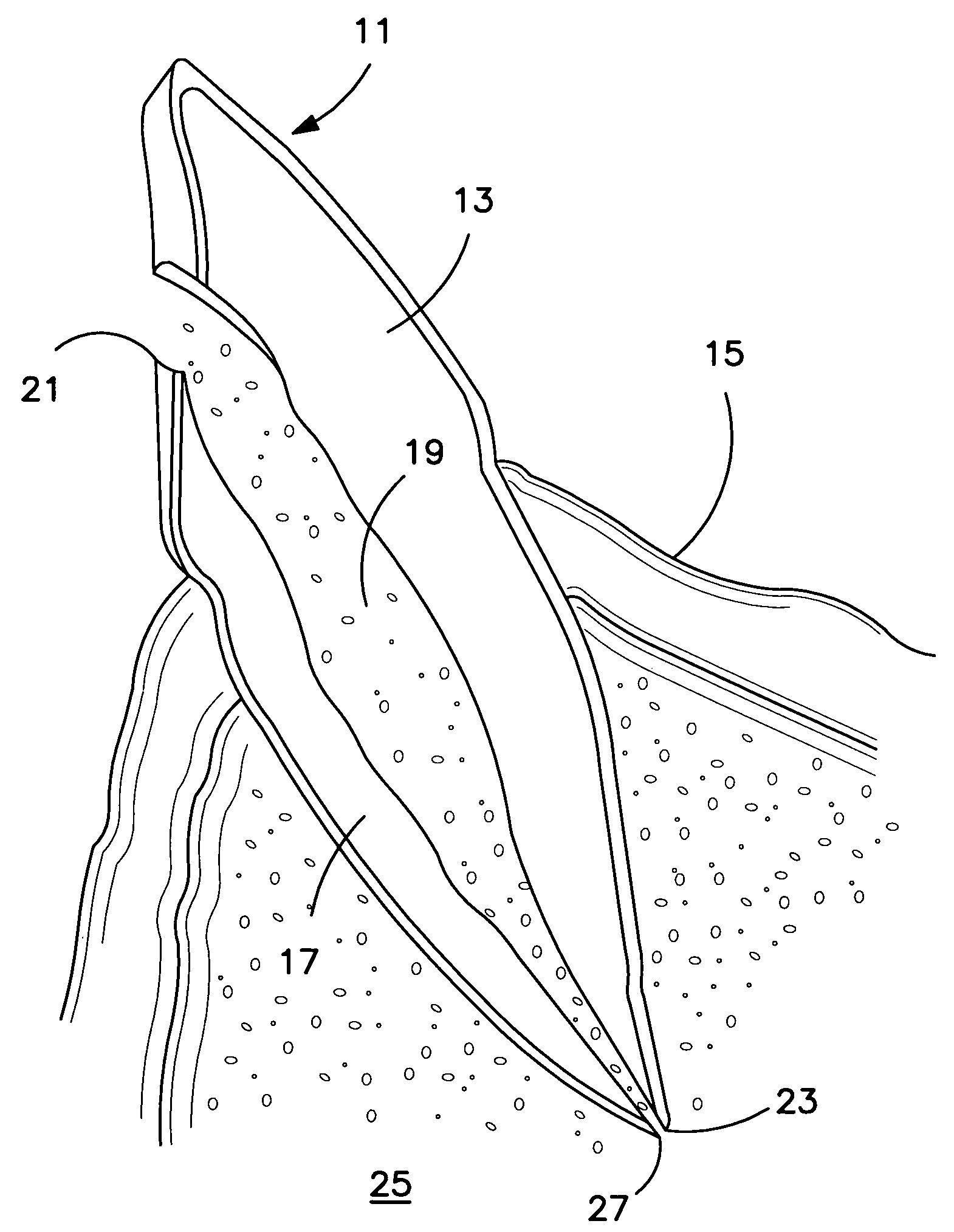 Apparatus for evacuation of root canal