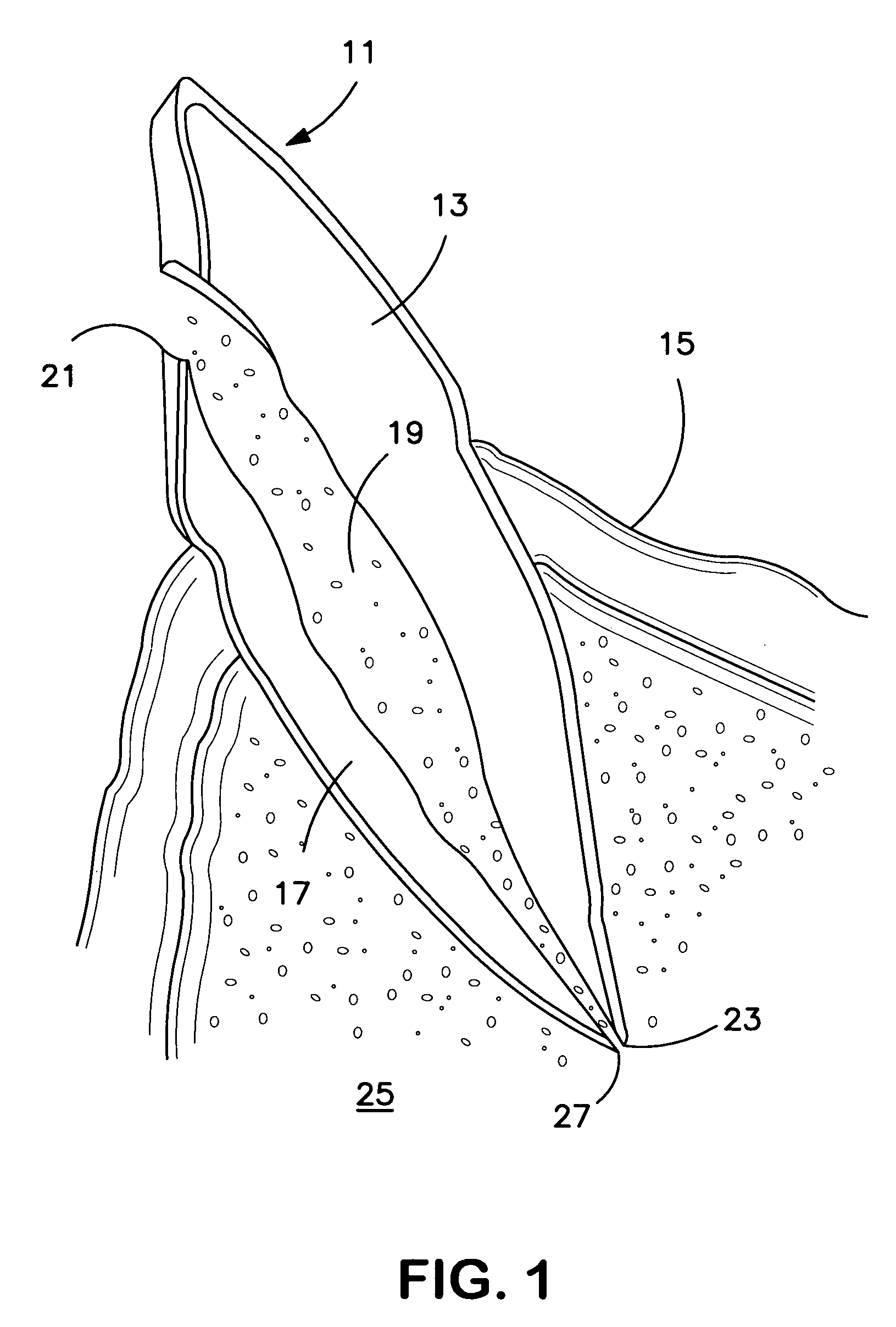 Apparatus for evacuation of root canal