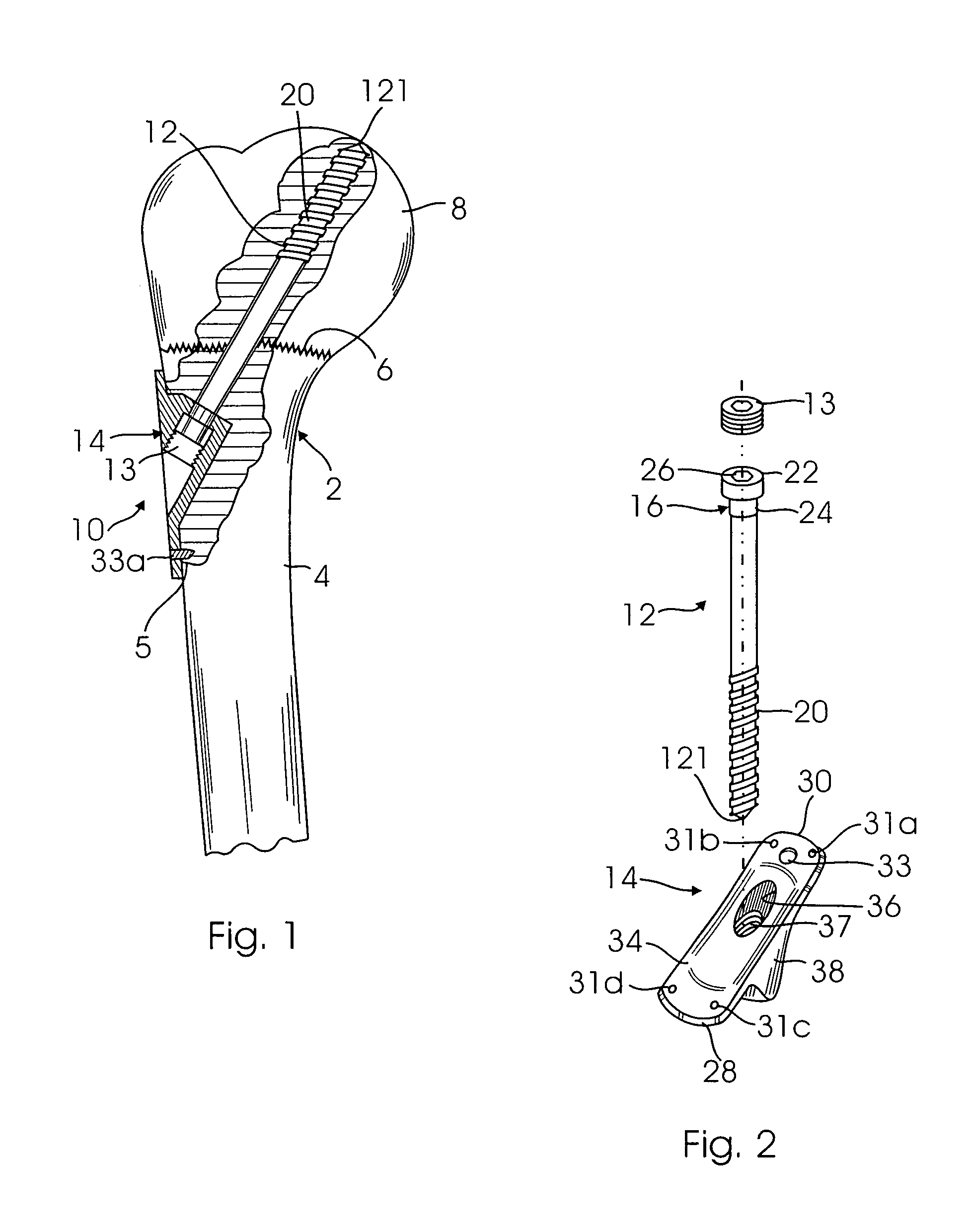 Odd angle internal bone fixation device for use in a transverse fracture of a humerus
