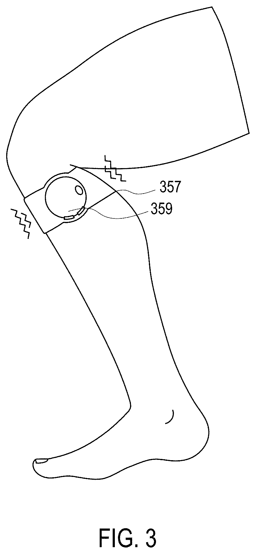 Systems, methods and devices for peripheral neuromodulation for treating diseases related to overactive bladder