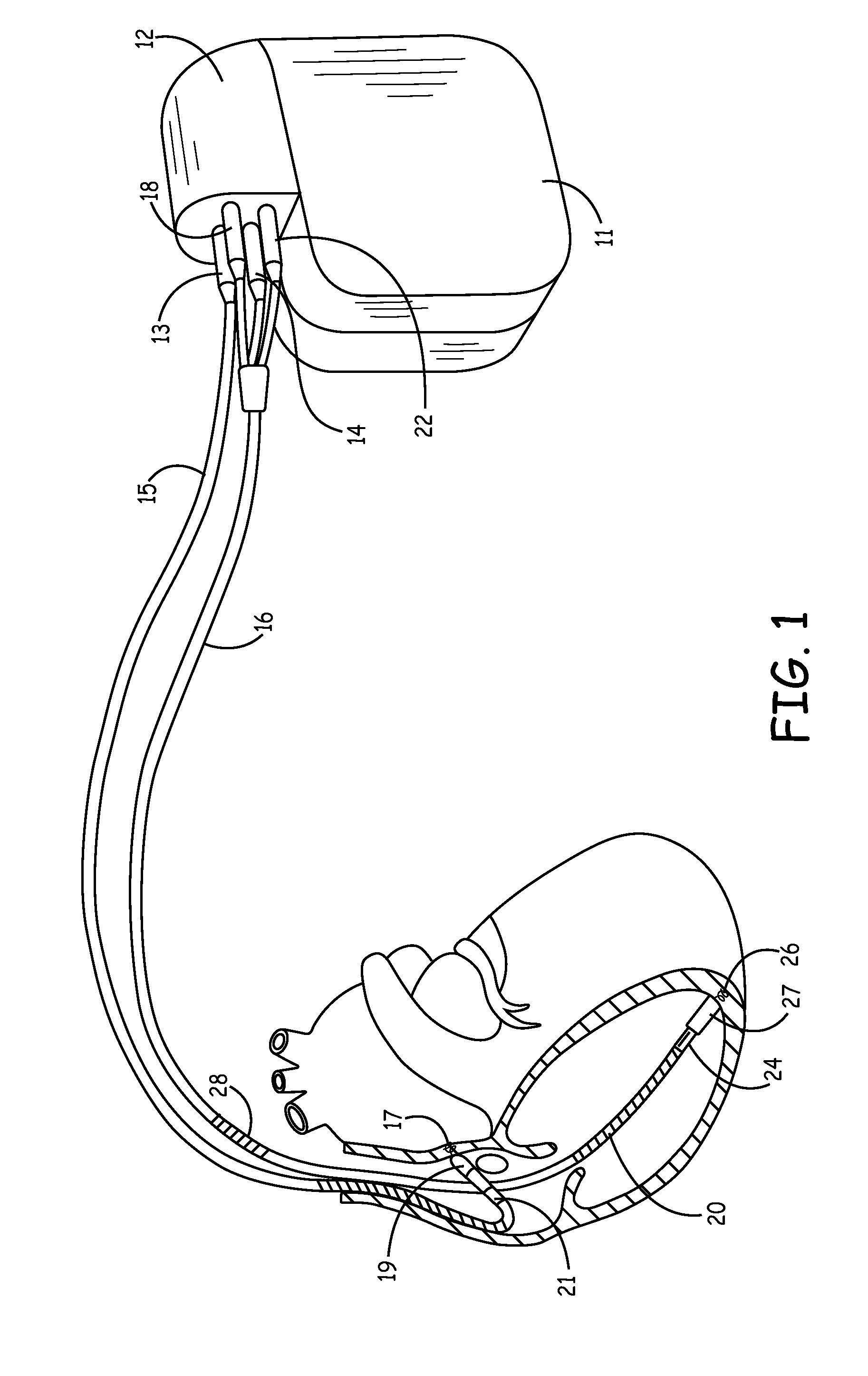 Method and apparatus for detecting and treating tachyarrhythmias incorporating diagnostic/therapeutic pacing techniques