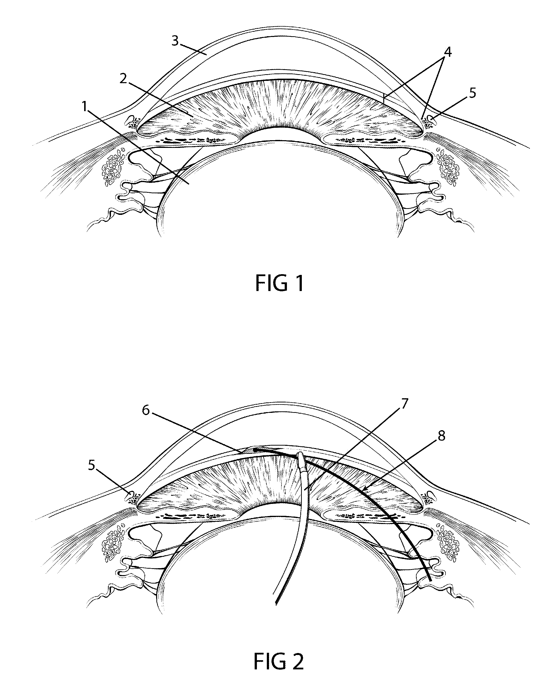 Method and apparatus for treating an ocular disorder
