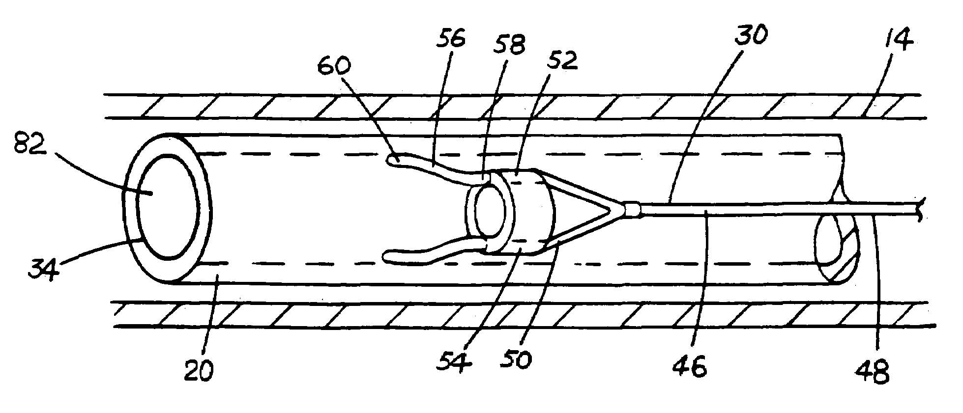 Device for anchoring tubular element