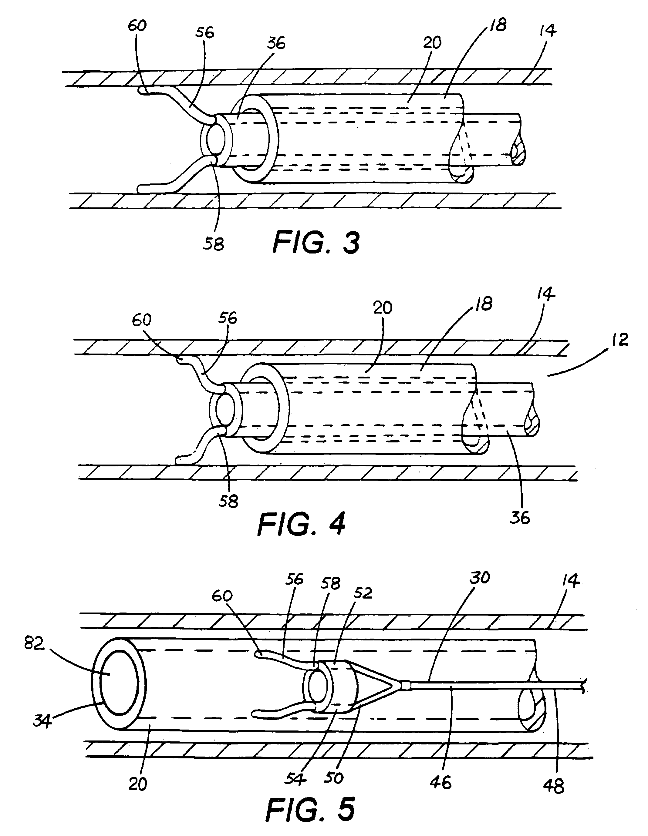 Device for anchoring tubular element