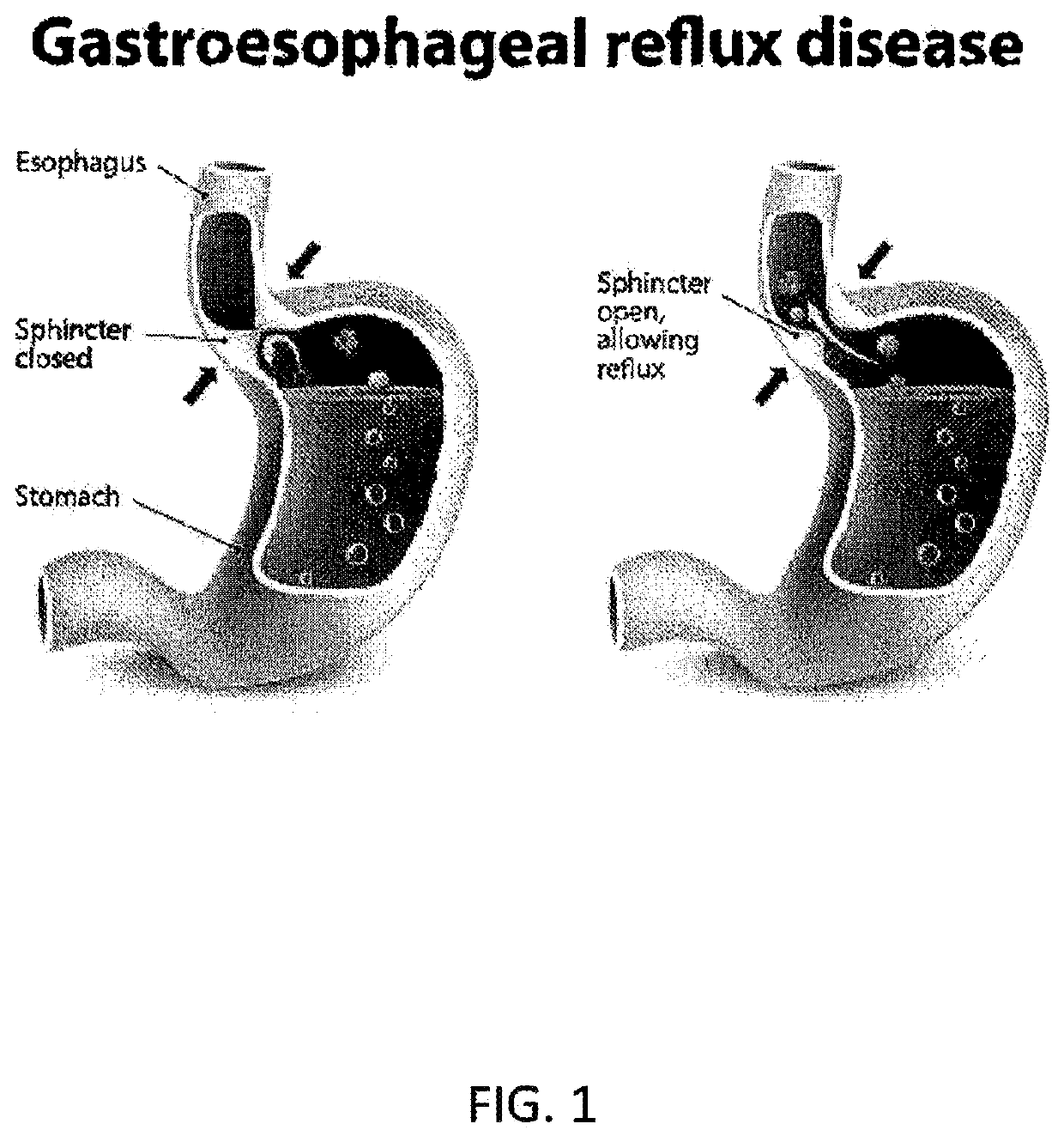 Method and System for Reducing the Likelihood of Colorectal Cancer in a Human Being