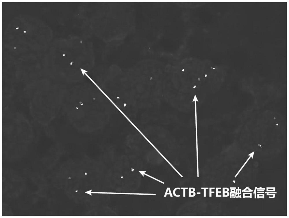 A probe combination and its application for diagnosing actb-tfeb translocation renal carcinoma