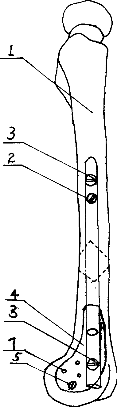 Internal fixator of interamedullary nail jined with steel plate