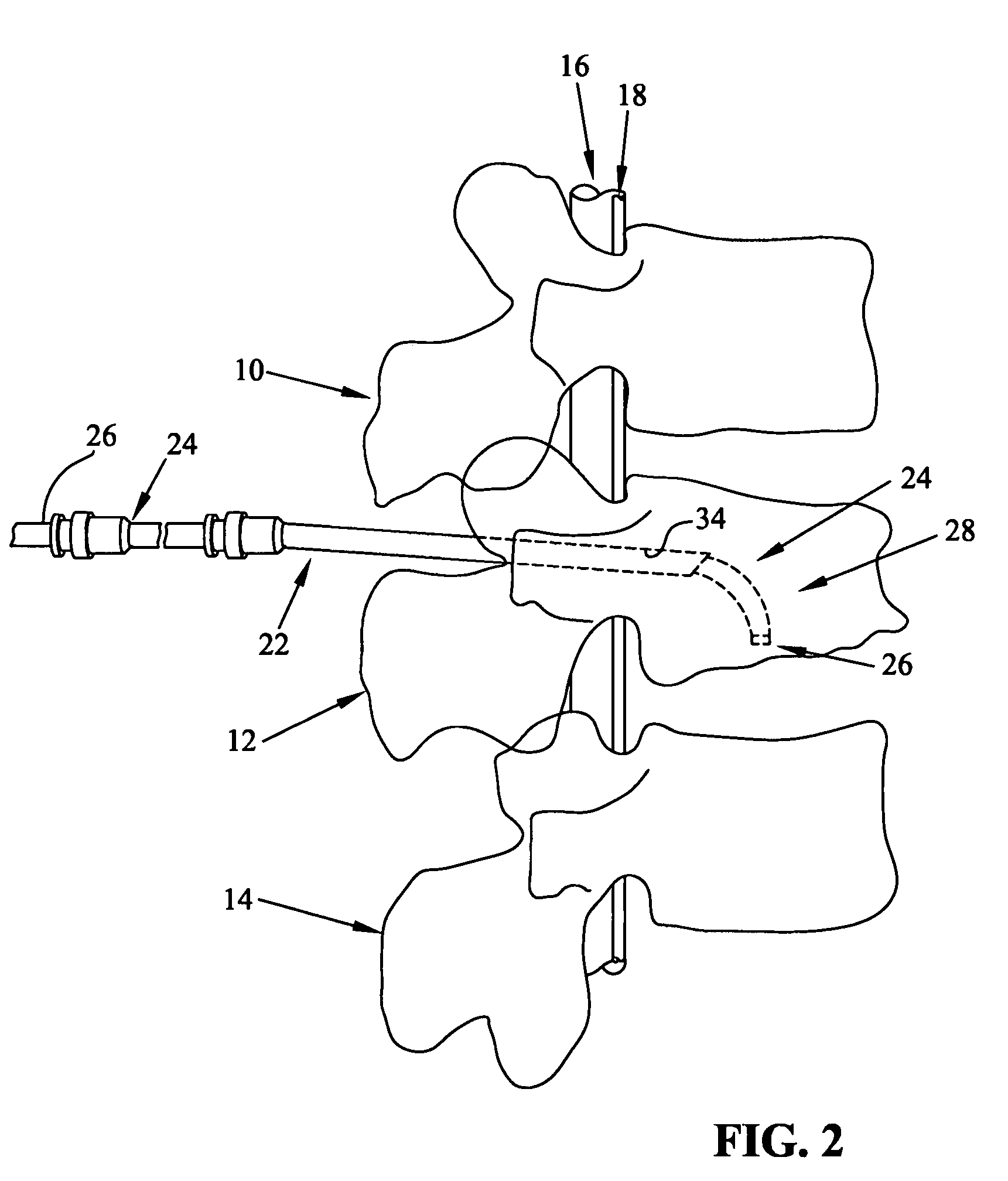 Spinal rod, insertion device, and method of using