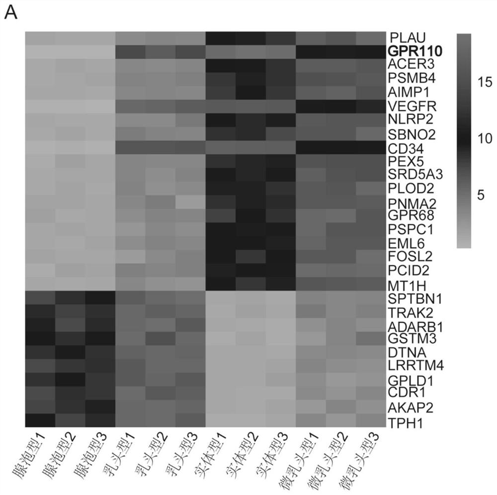 Application of GPR110, VEGFR and CD34 in identification of lung adenocarcinoma subtypes