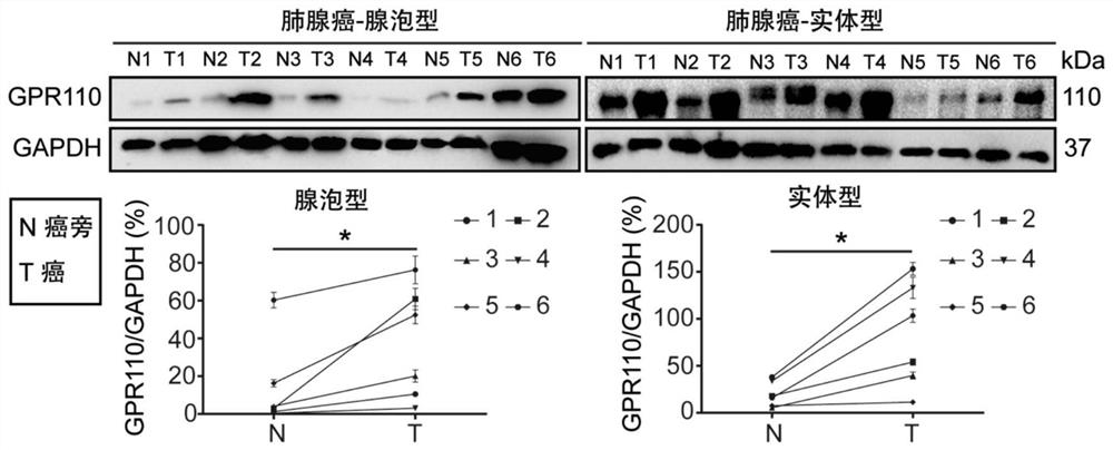 Application of GPR110, VEGFR and CD34 in identification of lung adenocarcinoma subtypes