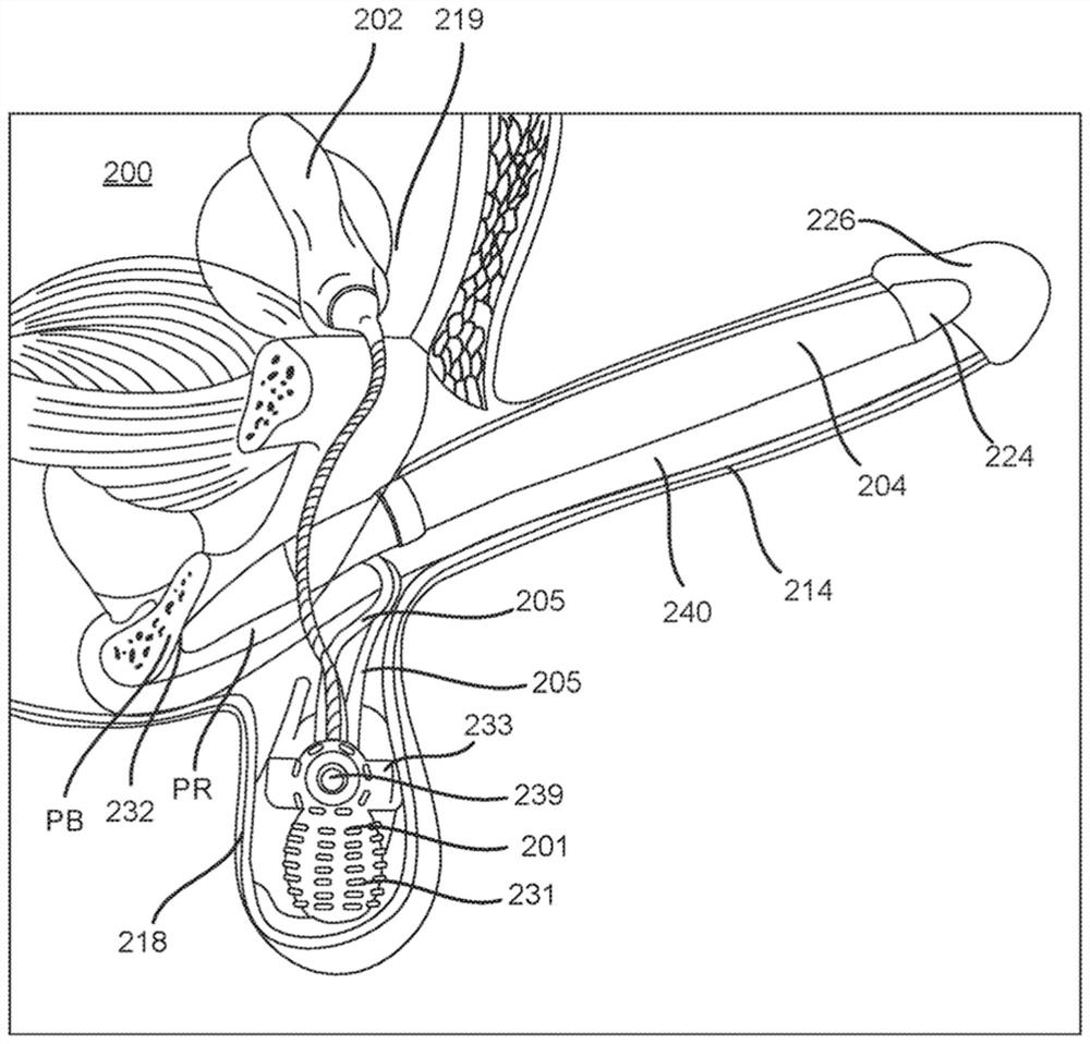 Inflatable penile prosthesis with valves for increasing flow efficiency