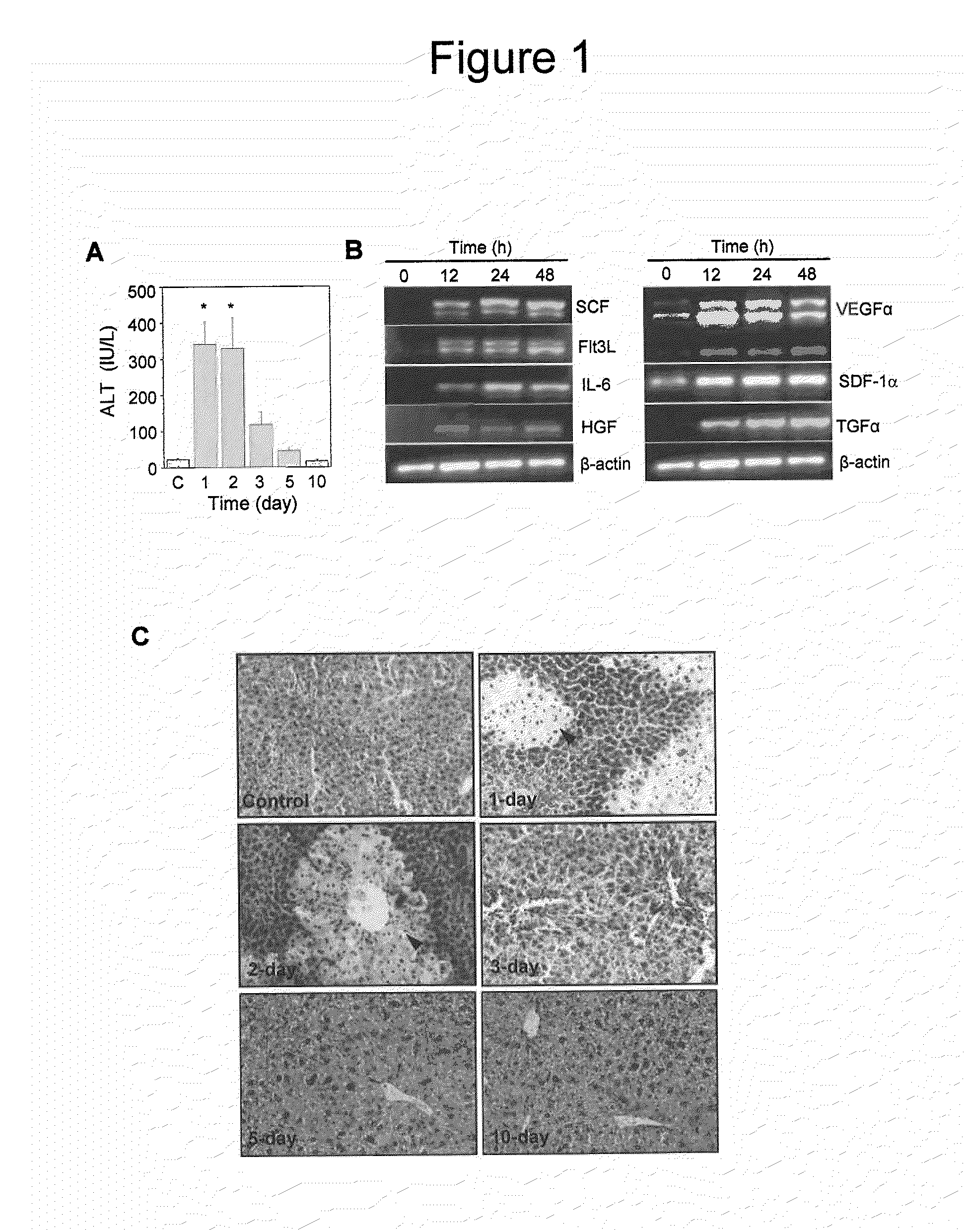 Method for the therapeutic correction of hemophilia a by transplanting bone marrow cells