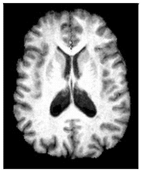 Non-rigid brain image registration method