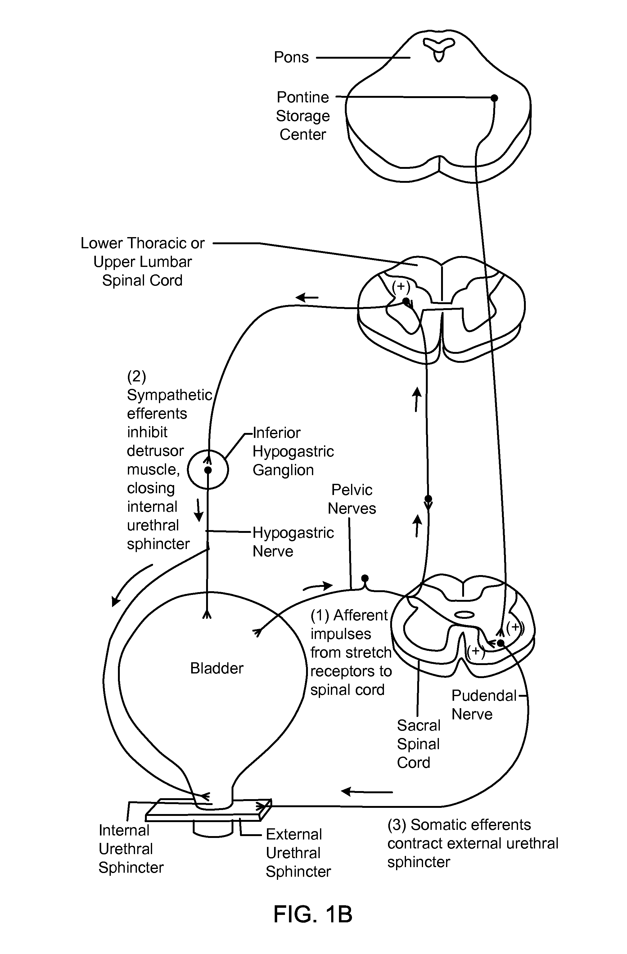 Electrical neuromodulation stimulation system and method for treating urinary incontinence