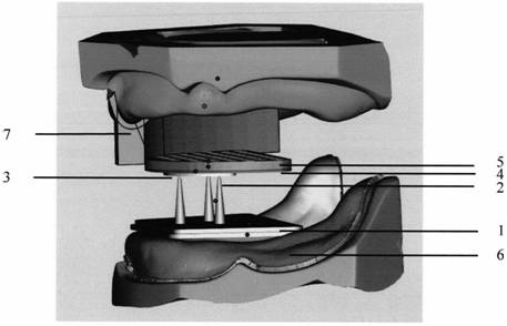 A Disposable Gothic Bow Tracer in the Mouth and a Method for Determining Median Relation Position