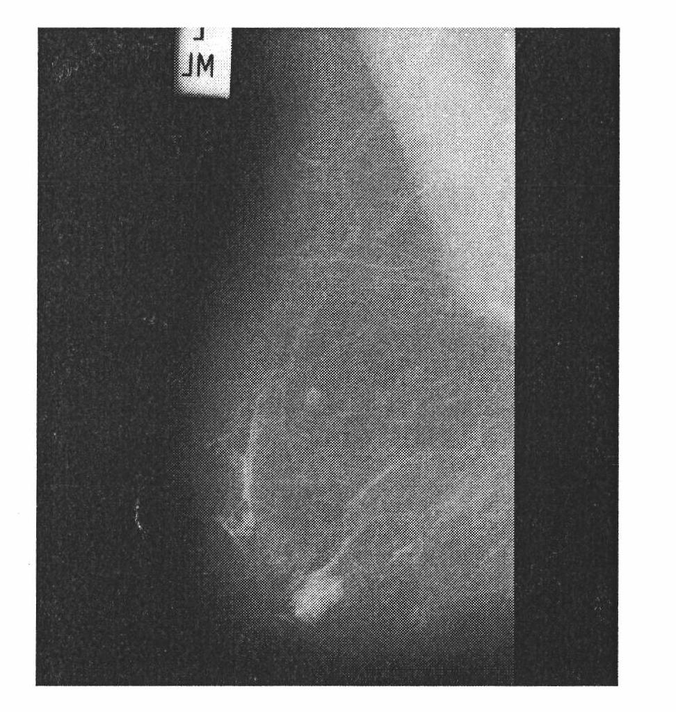 Medical image processing method based on dictionary studying upsampling