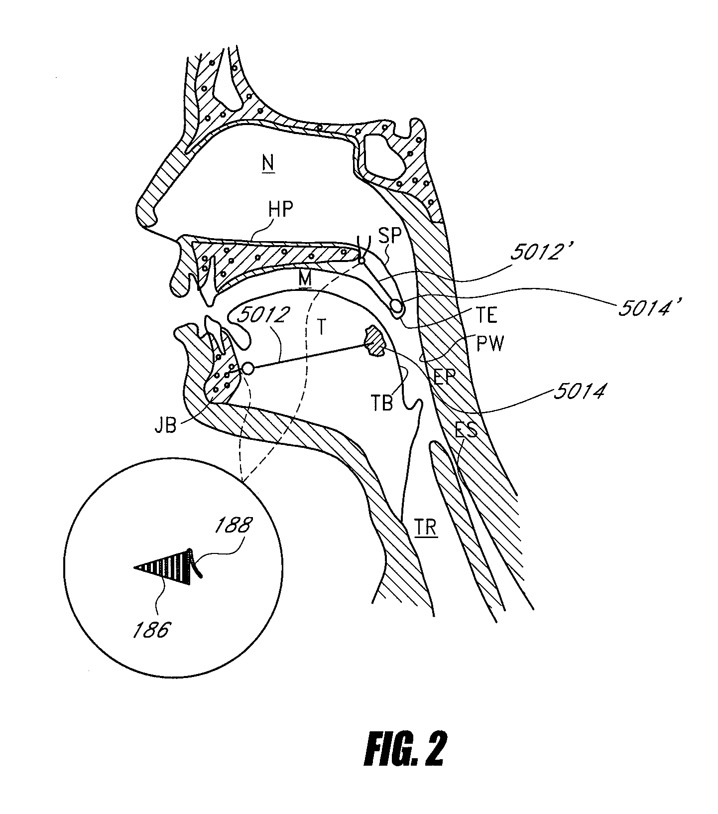 Airway implants and methods and devices for insertion and retrieval