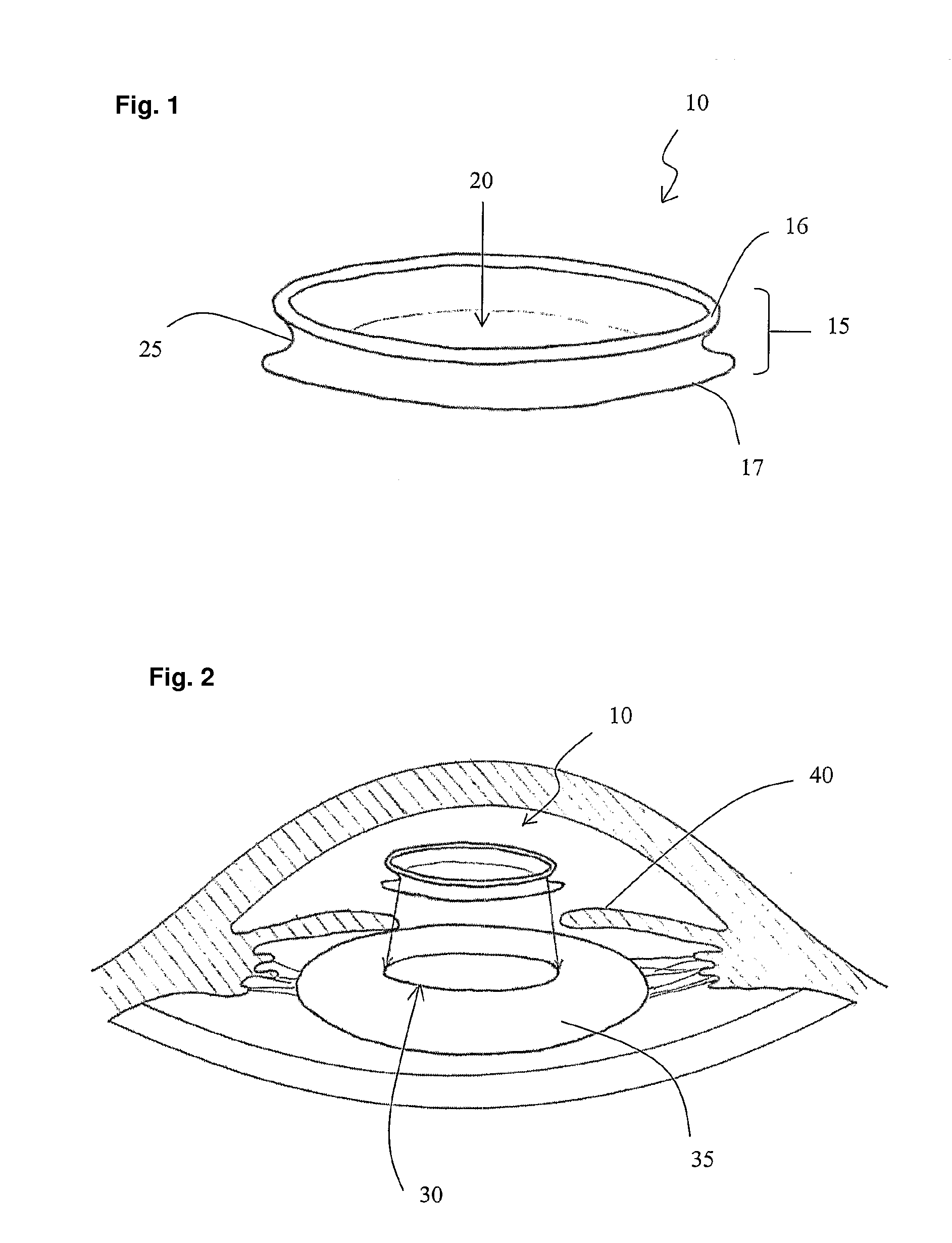 Method of maintaining the structure of an opening in the anterior or posterior capsule