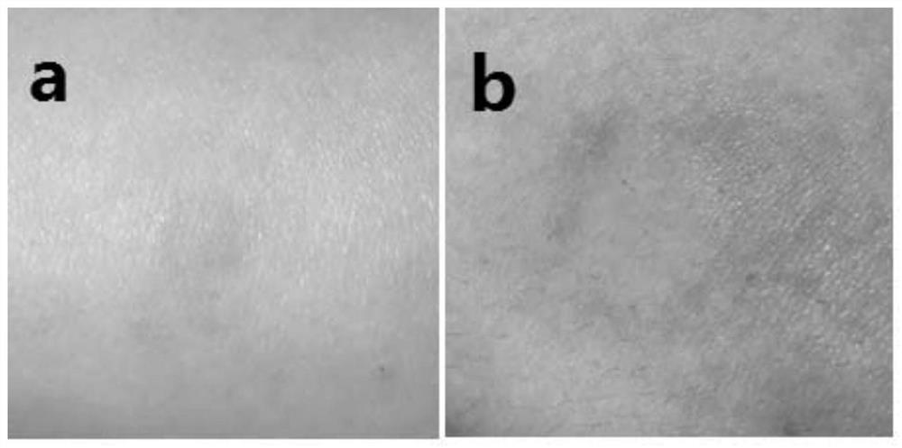 A micro -needle patch and preparation method containing Ren Er acid