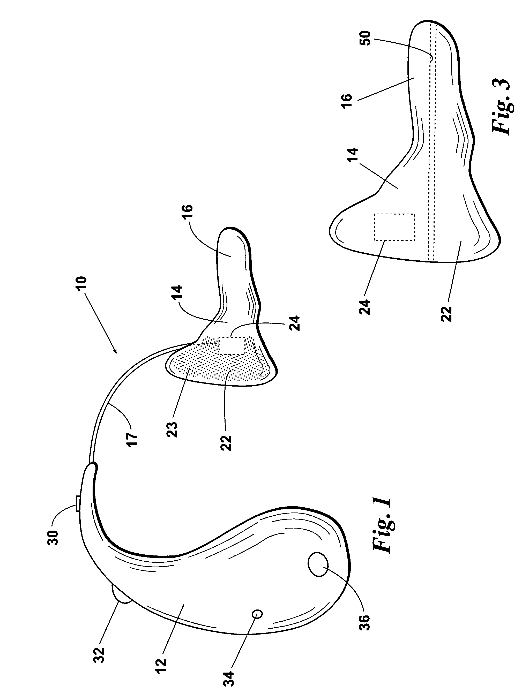 Bone conduction hearing assistance device