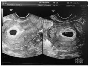 Application of human chorionic gonadotropin in preparation of pregnancy assisting medicine for patients with premature ovarian insufficiency