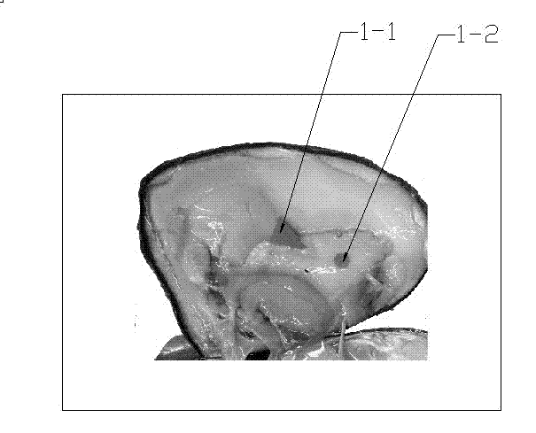 Method of embedding nuclei inside hyriopsis schlegeli for breeding oversized round-shaped pearls