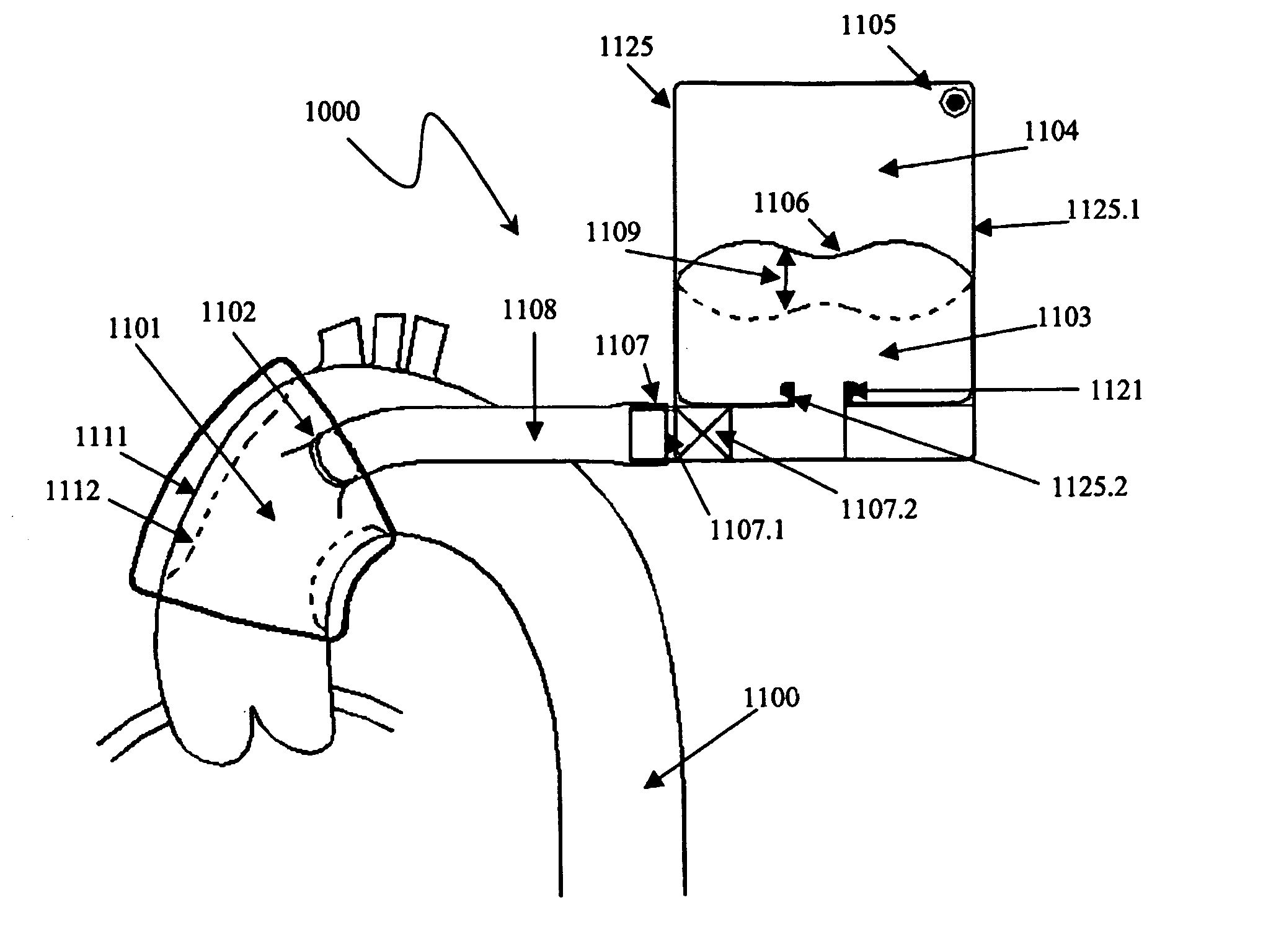 Vessel or sac wall treatment and a cardiac assist device