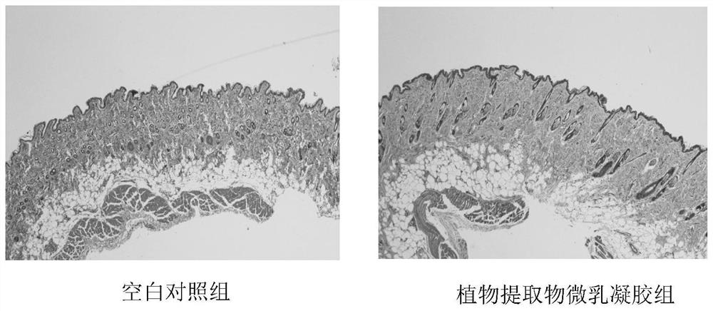 A kind of microemulsion gel of anti-HPV plant extract and preparation method and application thereof