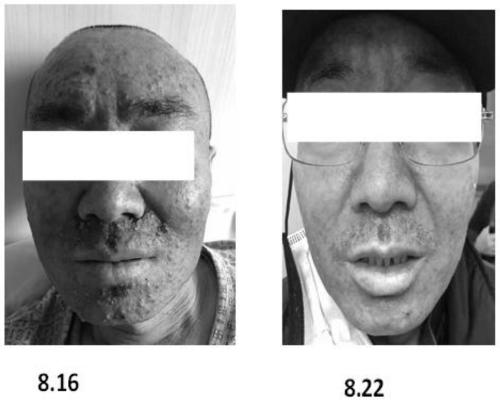 Purely traditional Chinese medicine facial mask capable of relieving rash relevant to tumor target medicines, and preparation method of purely traditional Chinese medicine facial mask capable of relieving rash relevant to tumor target medicines
