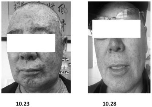 Purely traditional Chinese medicine facial mask capable of relieving rash relevant to tumor target medicines, and preparation method of purely traditional Chinese medicine facial mask capable of relieving rash relevant to tumor target medicines