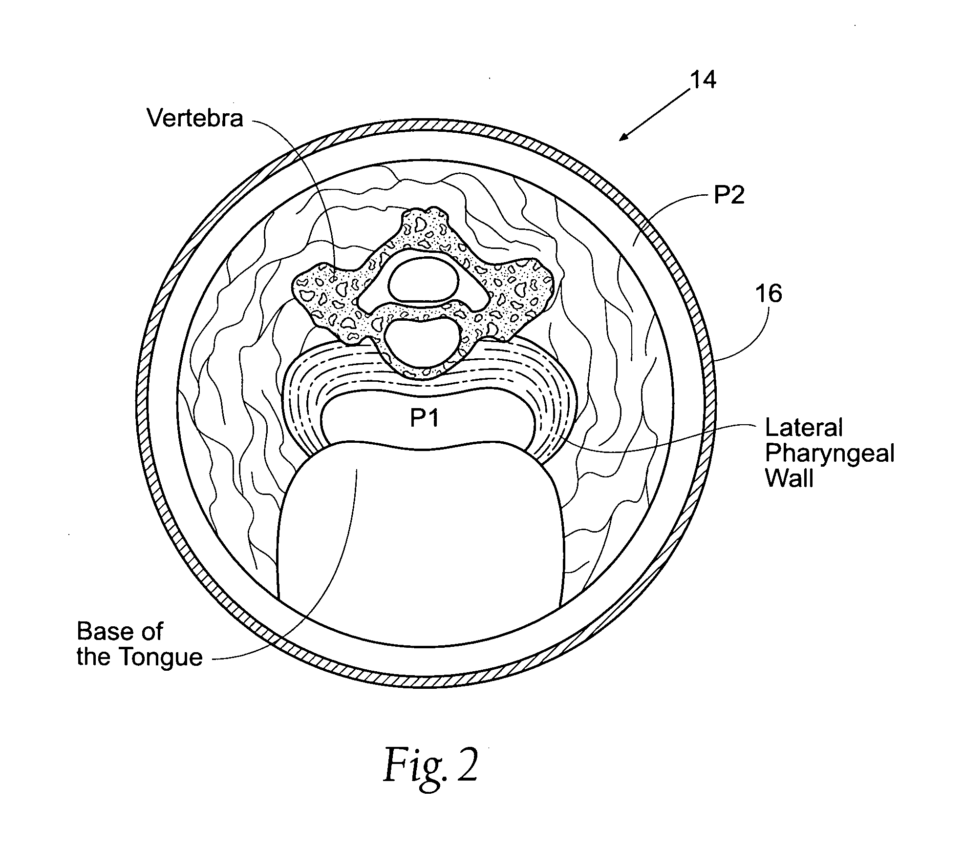 Devices, systems, and methods to fixate tissue within the regions of body, such as the pharyngeal conduit